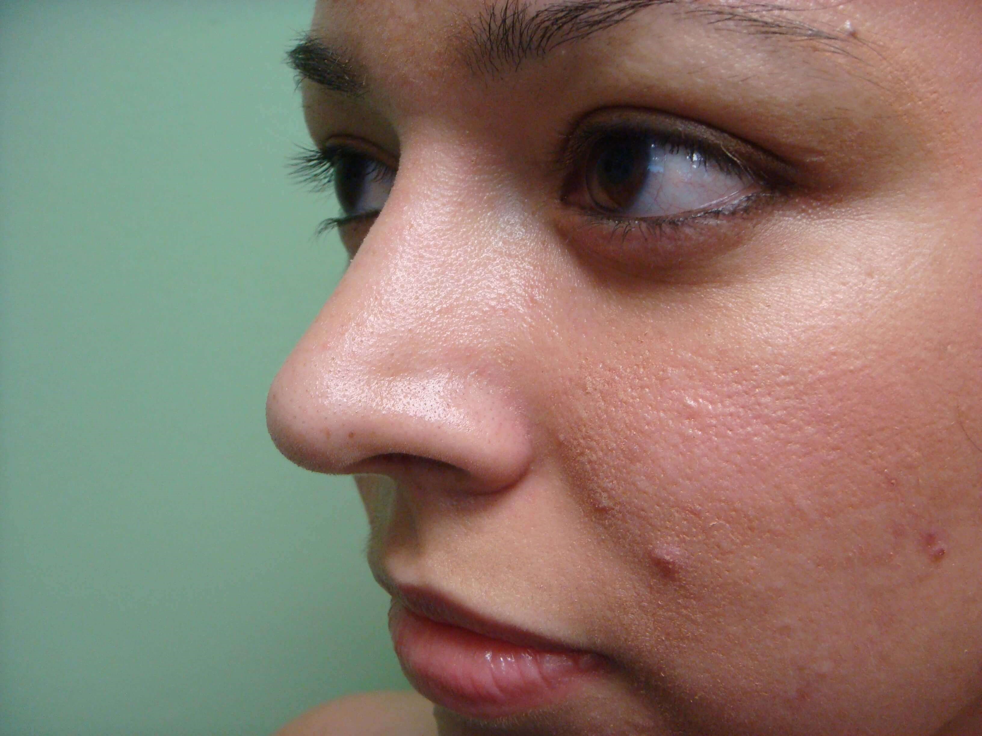 Rhinoplasty After