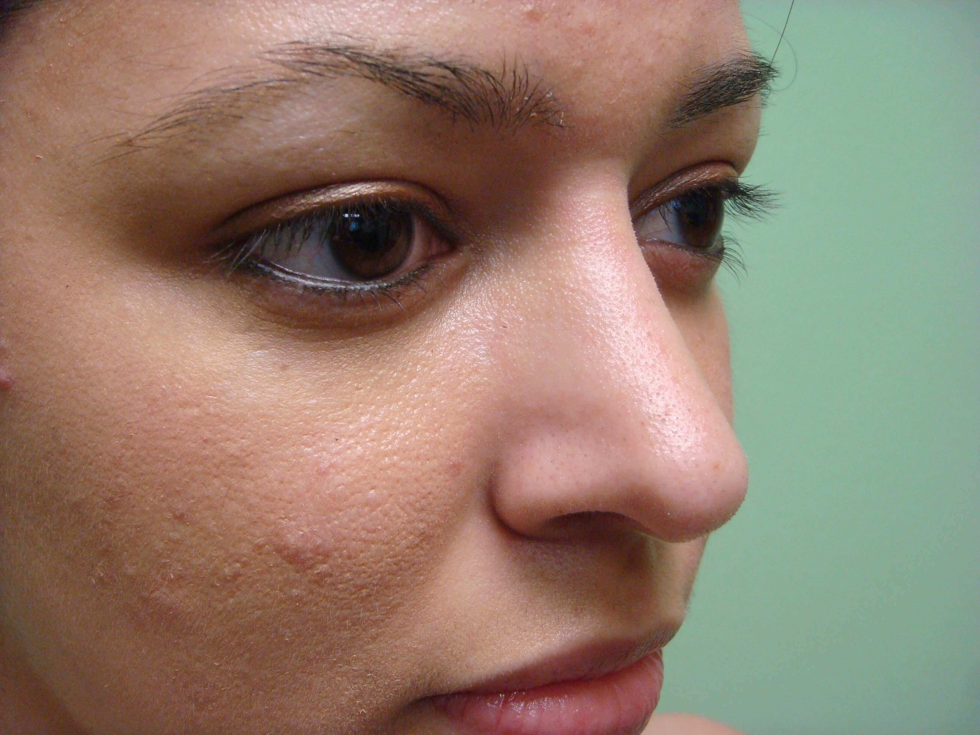 Rhinoplasty After