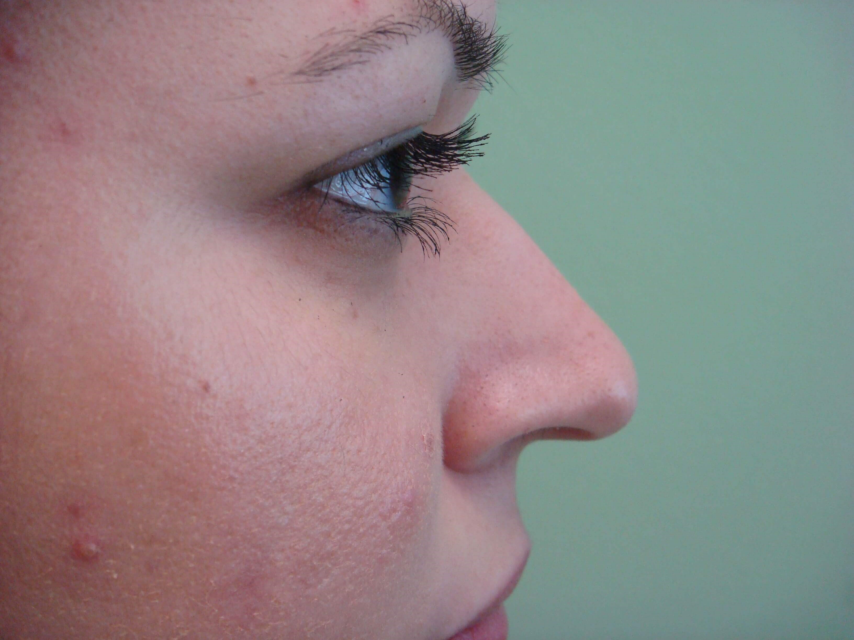 Rhinoplasty Before