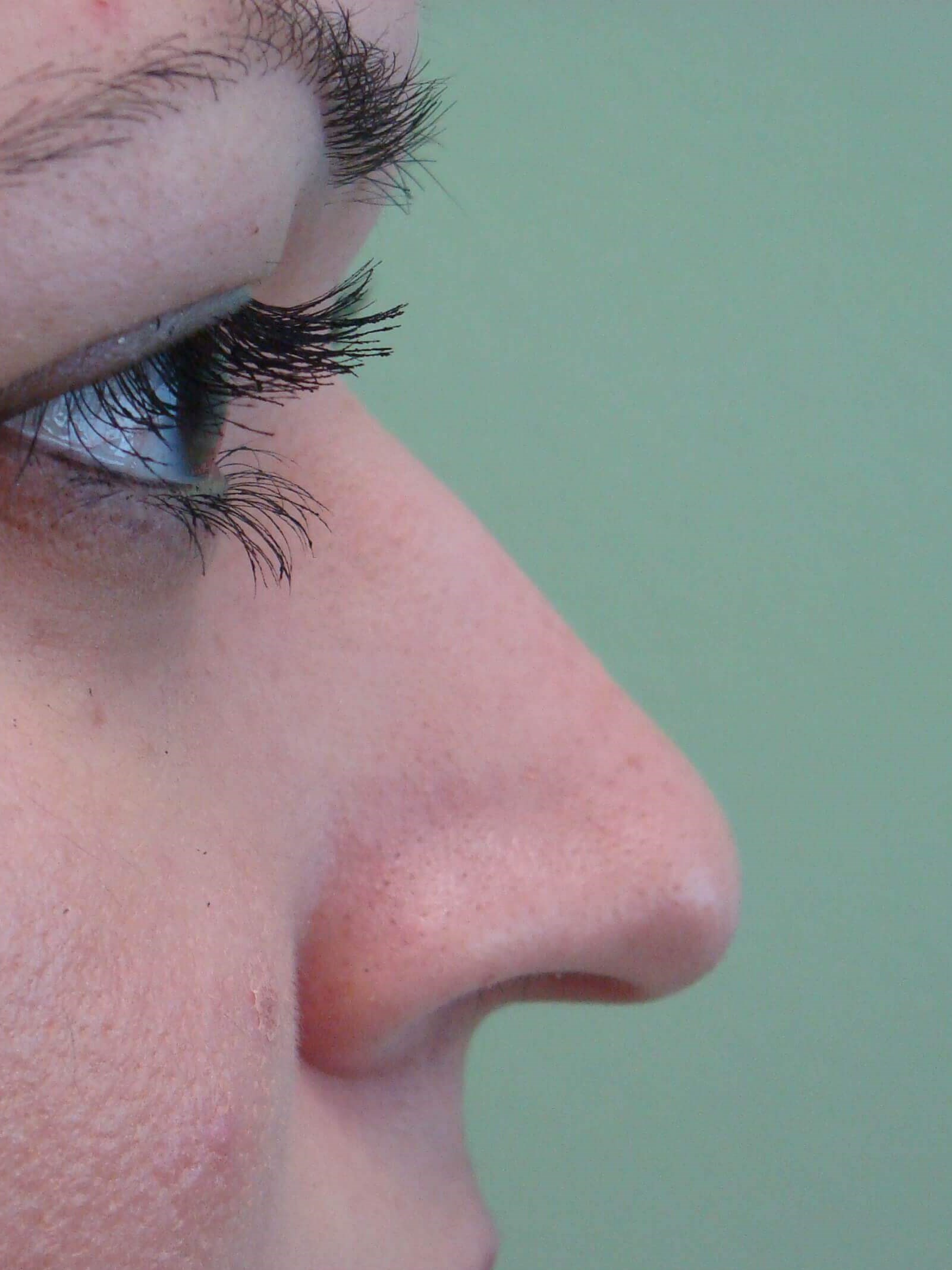 Rhinoplasty Before