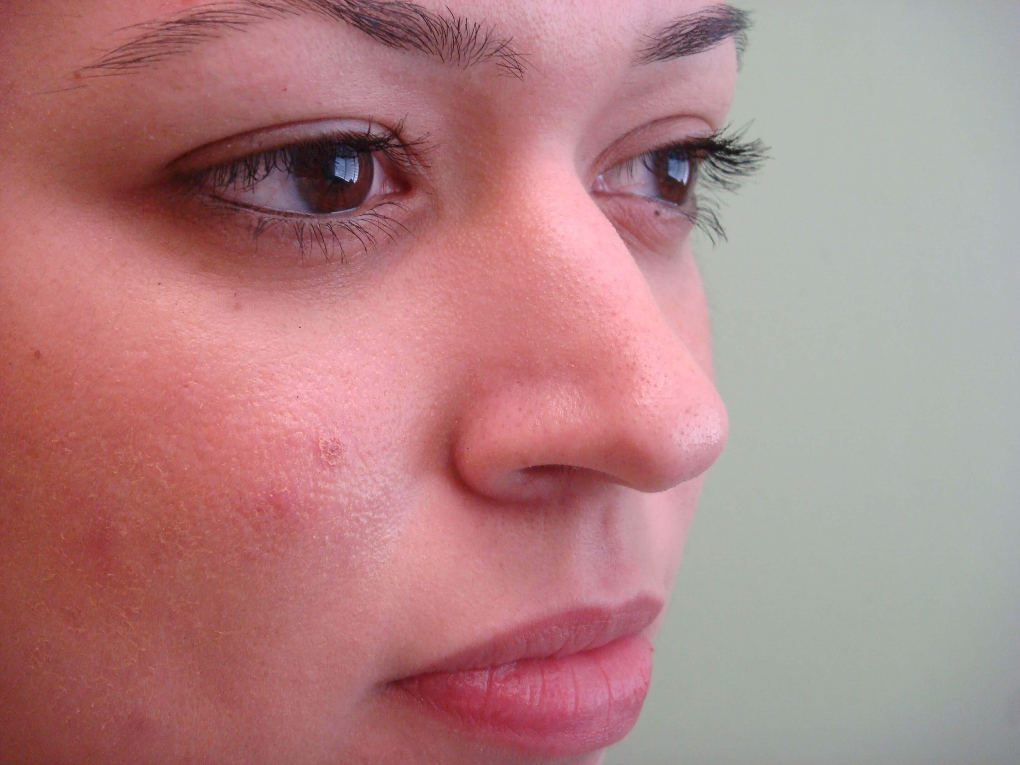 Rhinoplasty Before