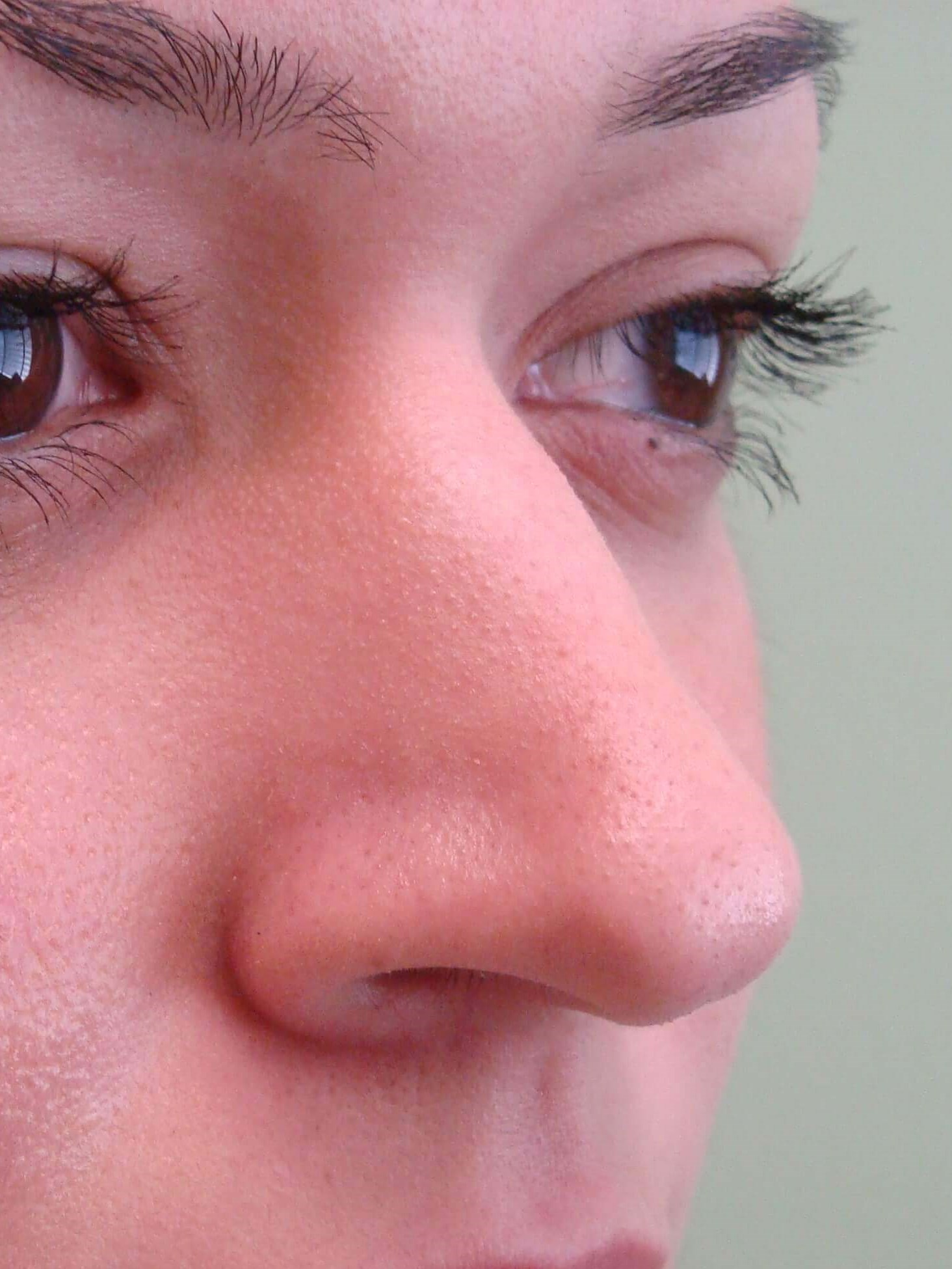 Rhinoplasty Before