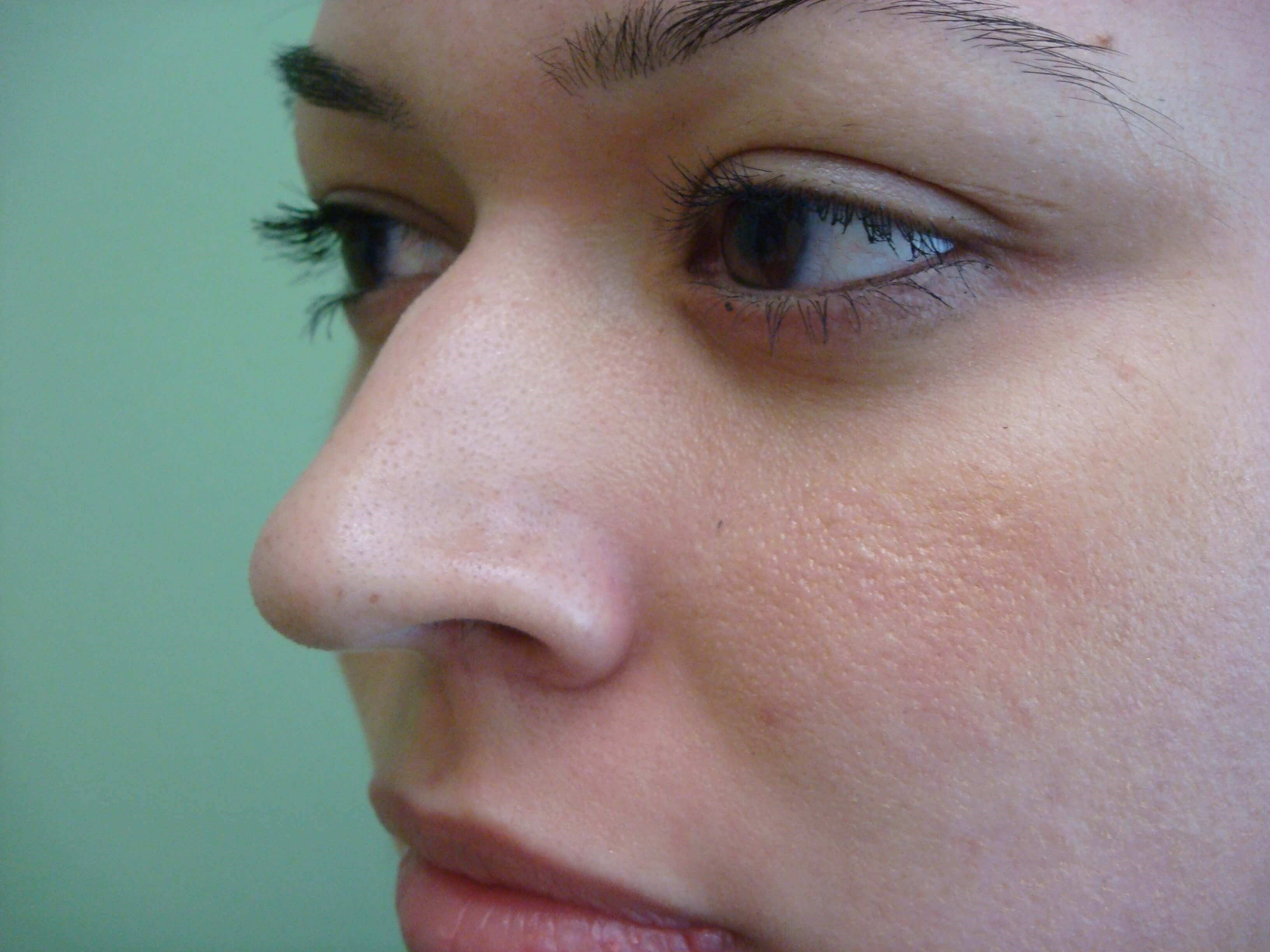 Rhinoplasty Before