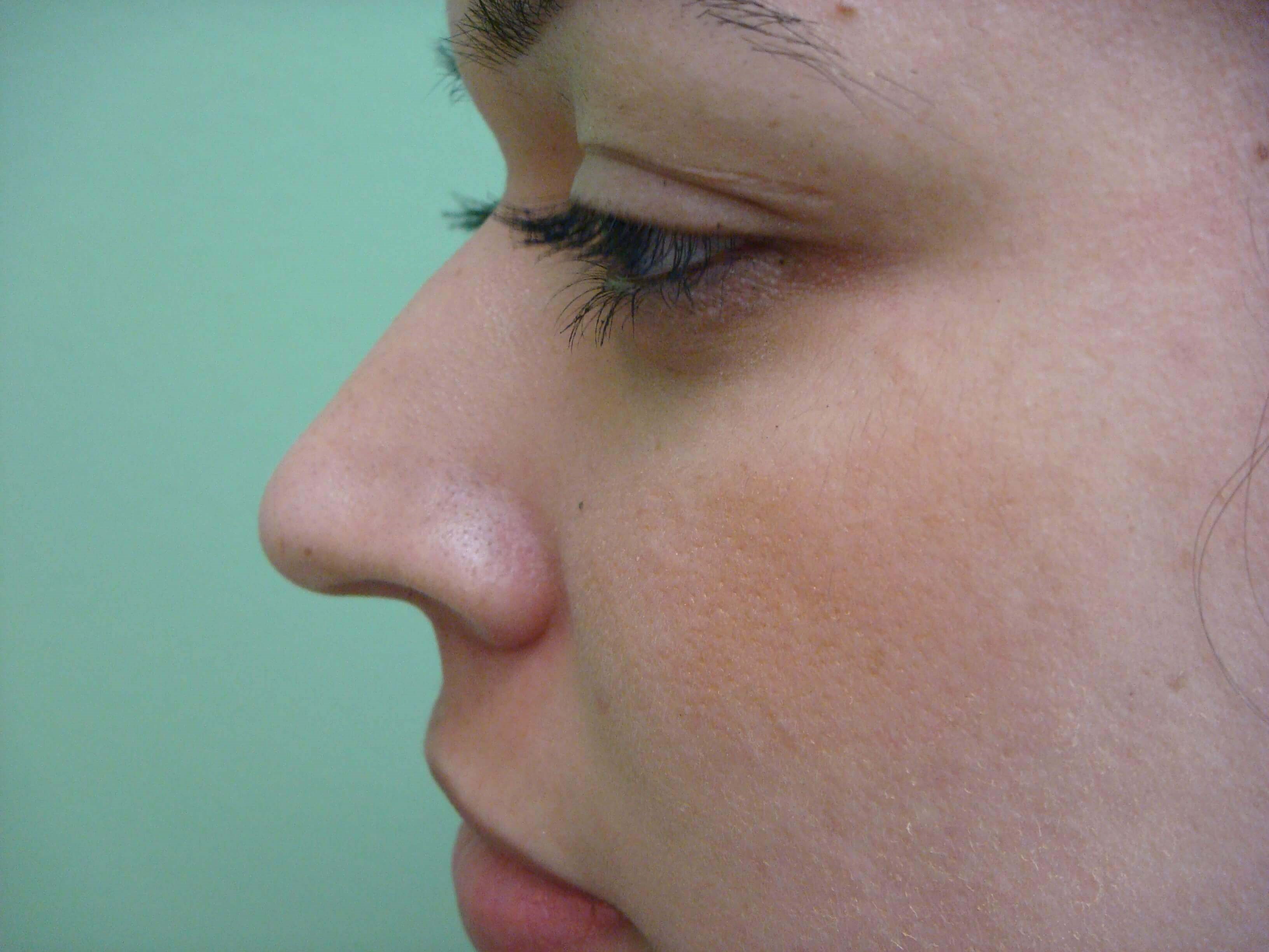Rhinoplasty Before