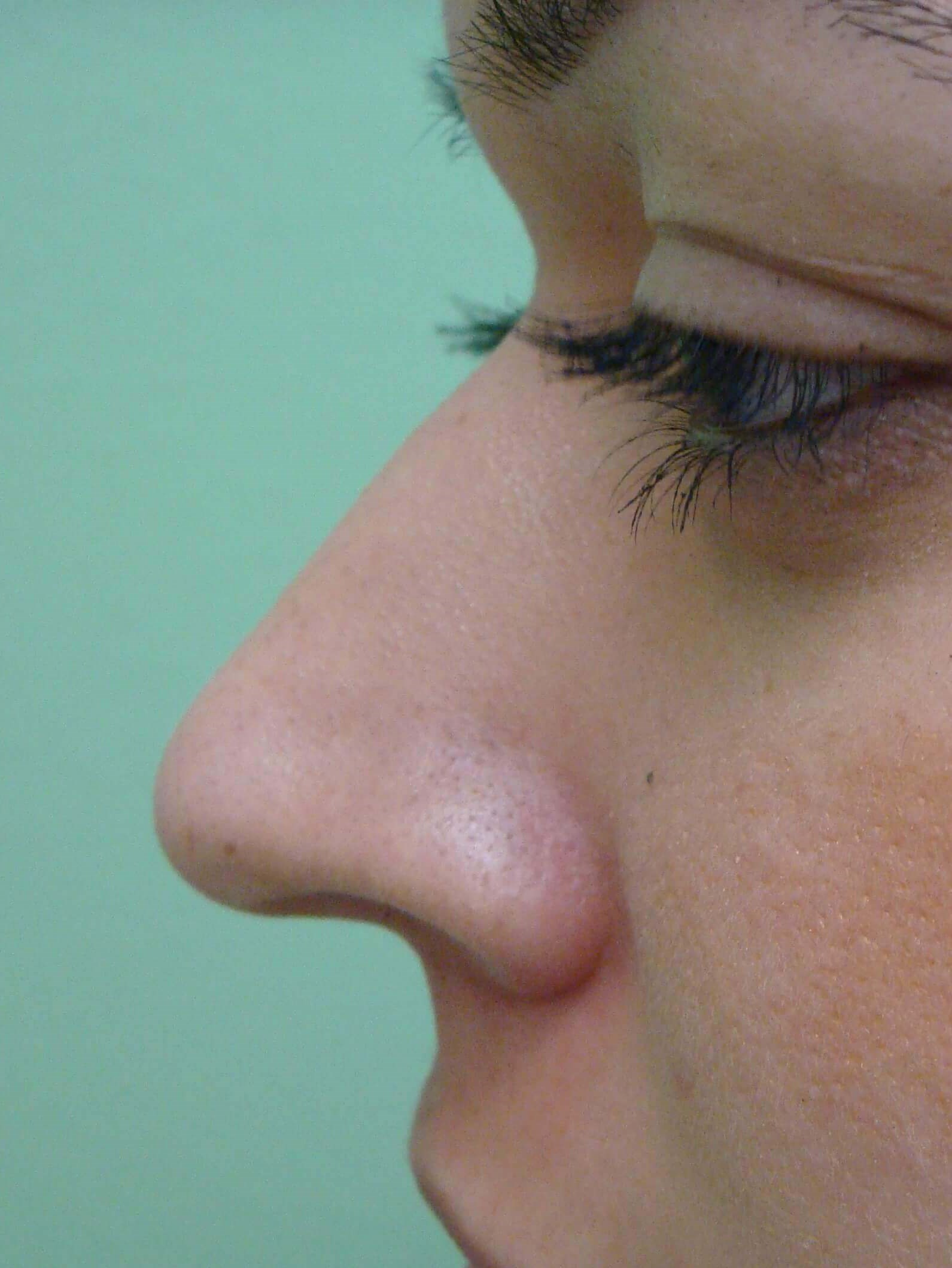 Rhinoplasty Before