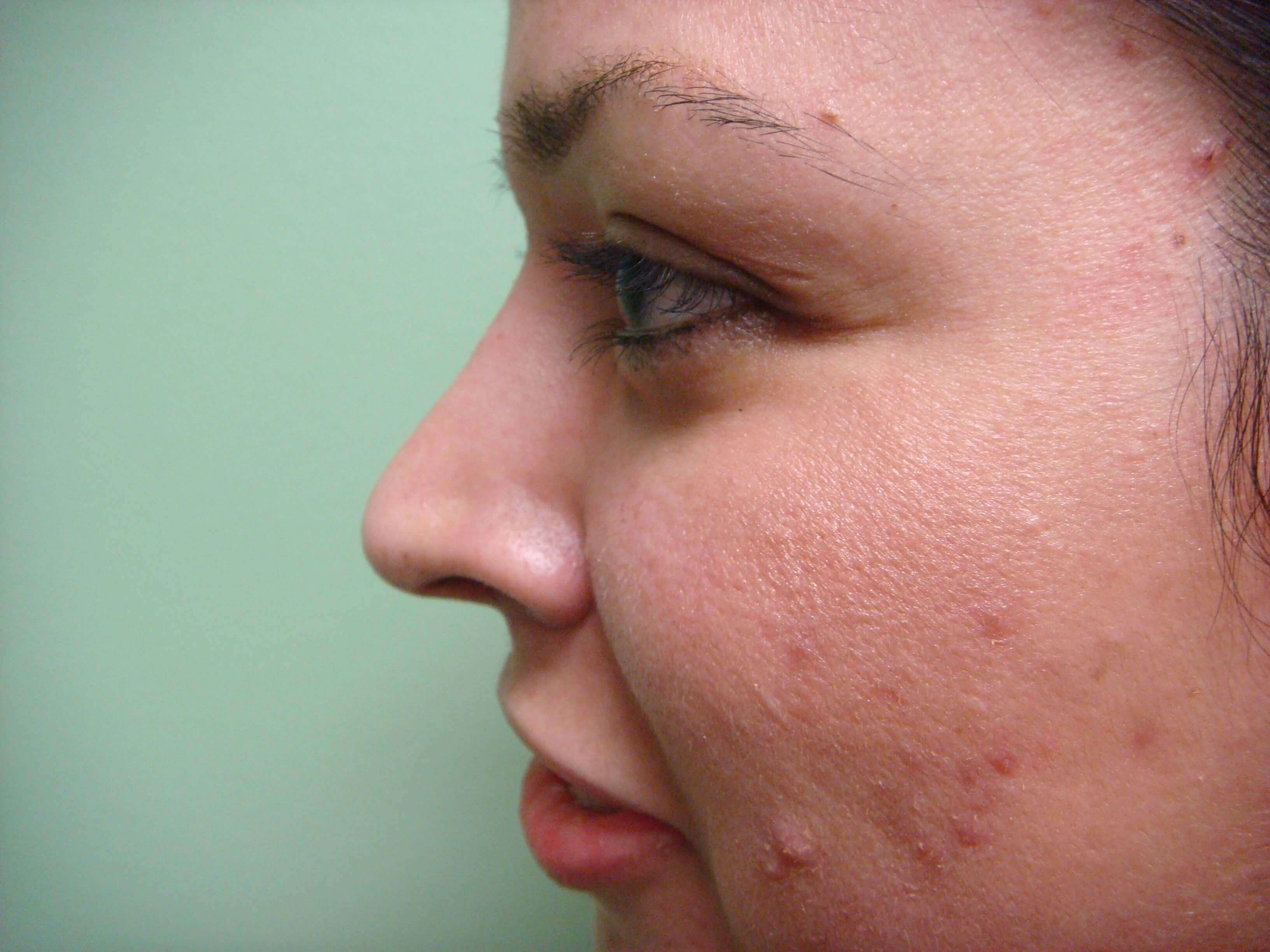 Rhinoplasty After
