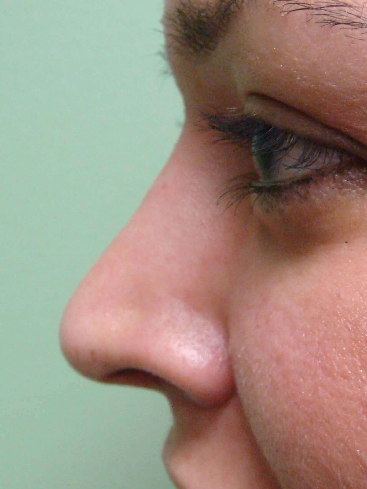 Rhinoplasty After