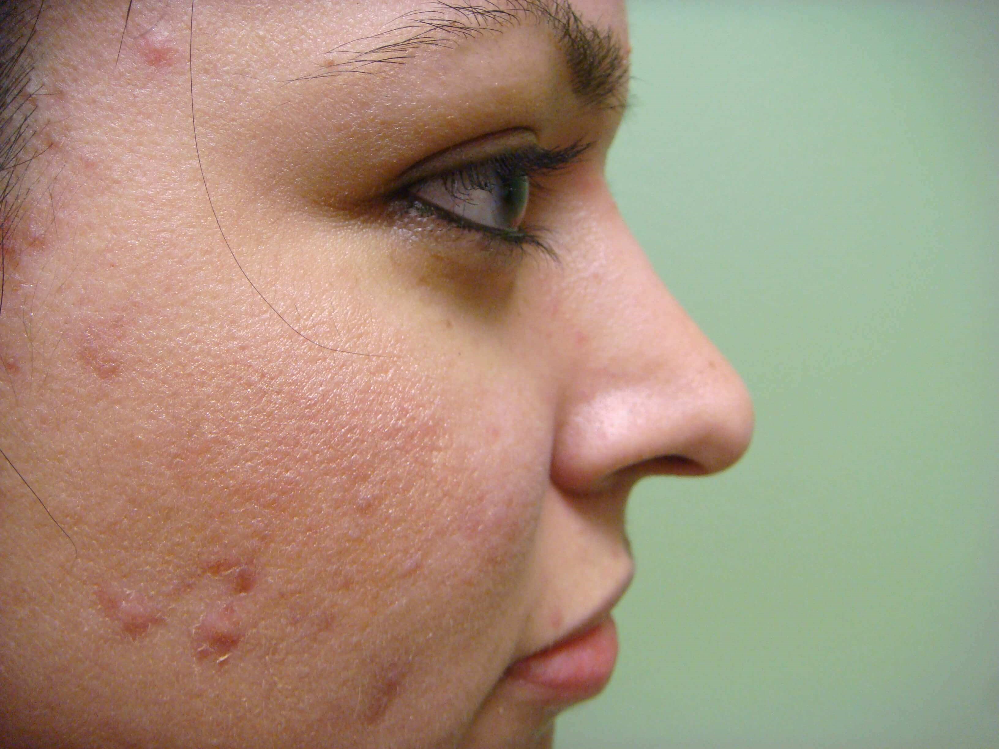 Rhinoplasty After