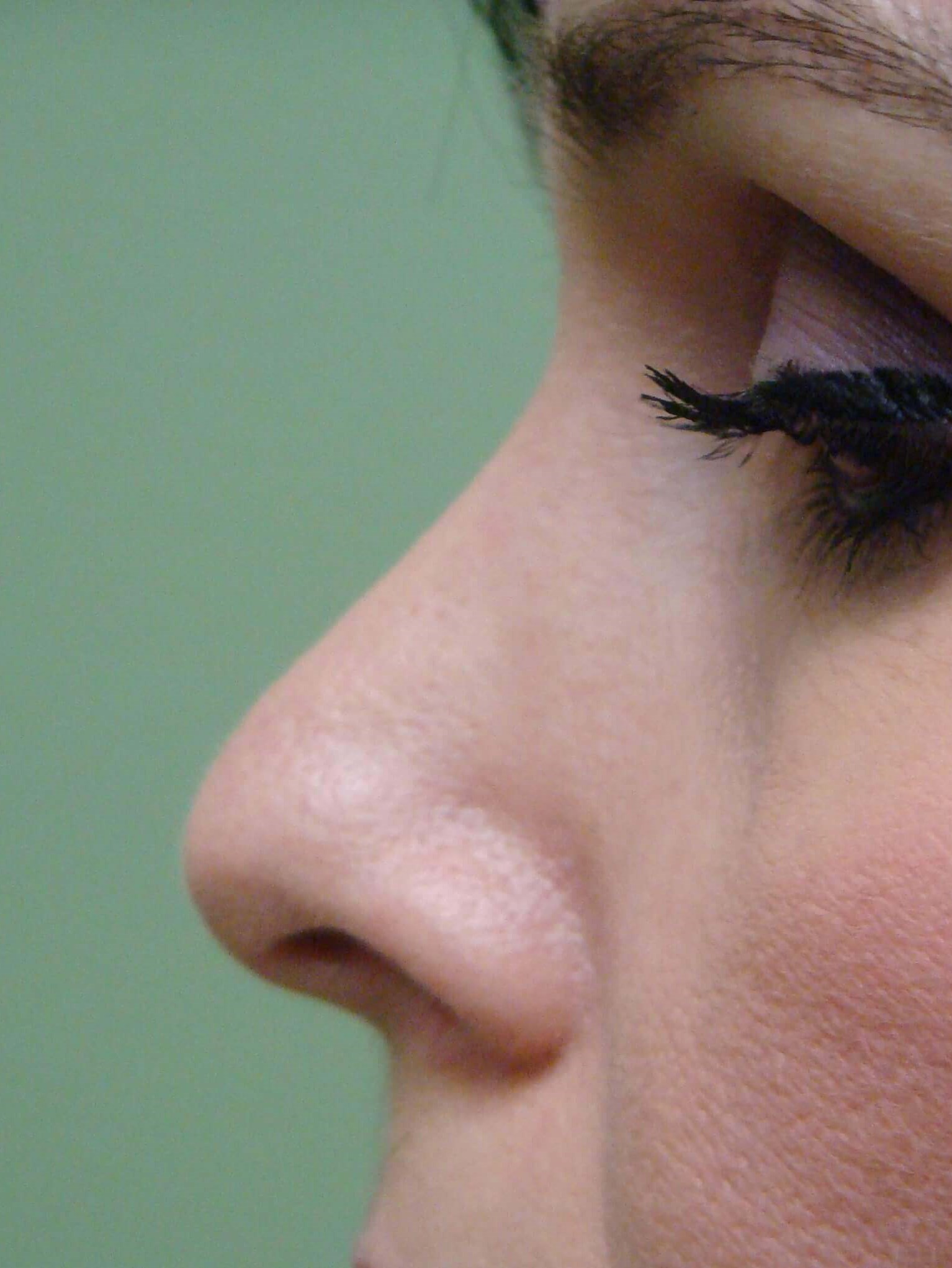Rhinoplasty After