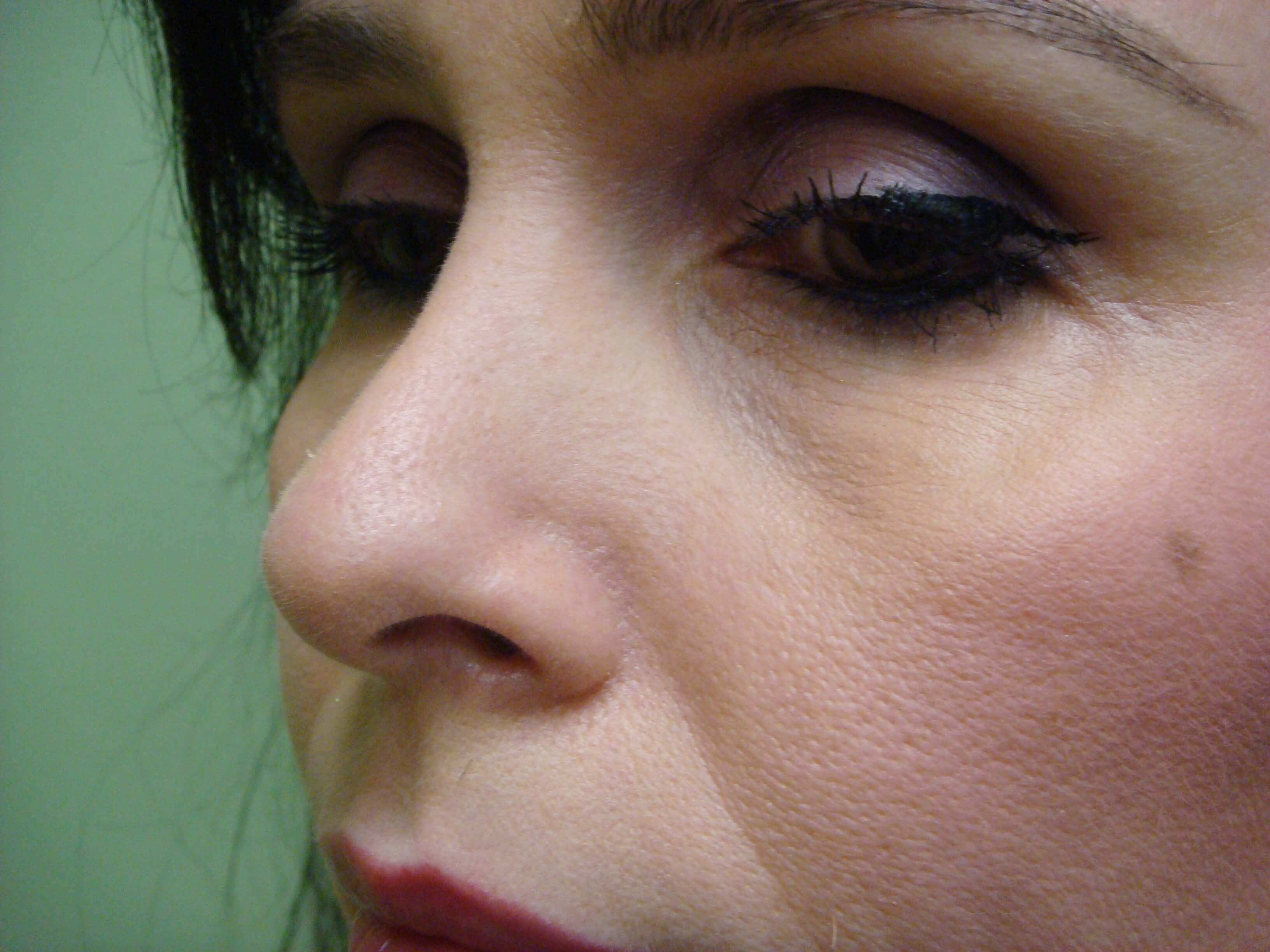 Rhinoplasty After