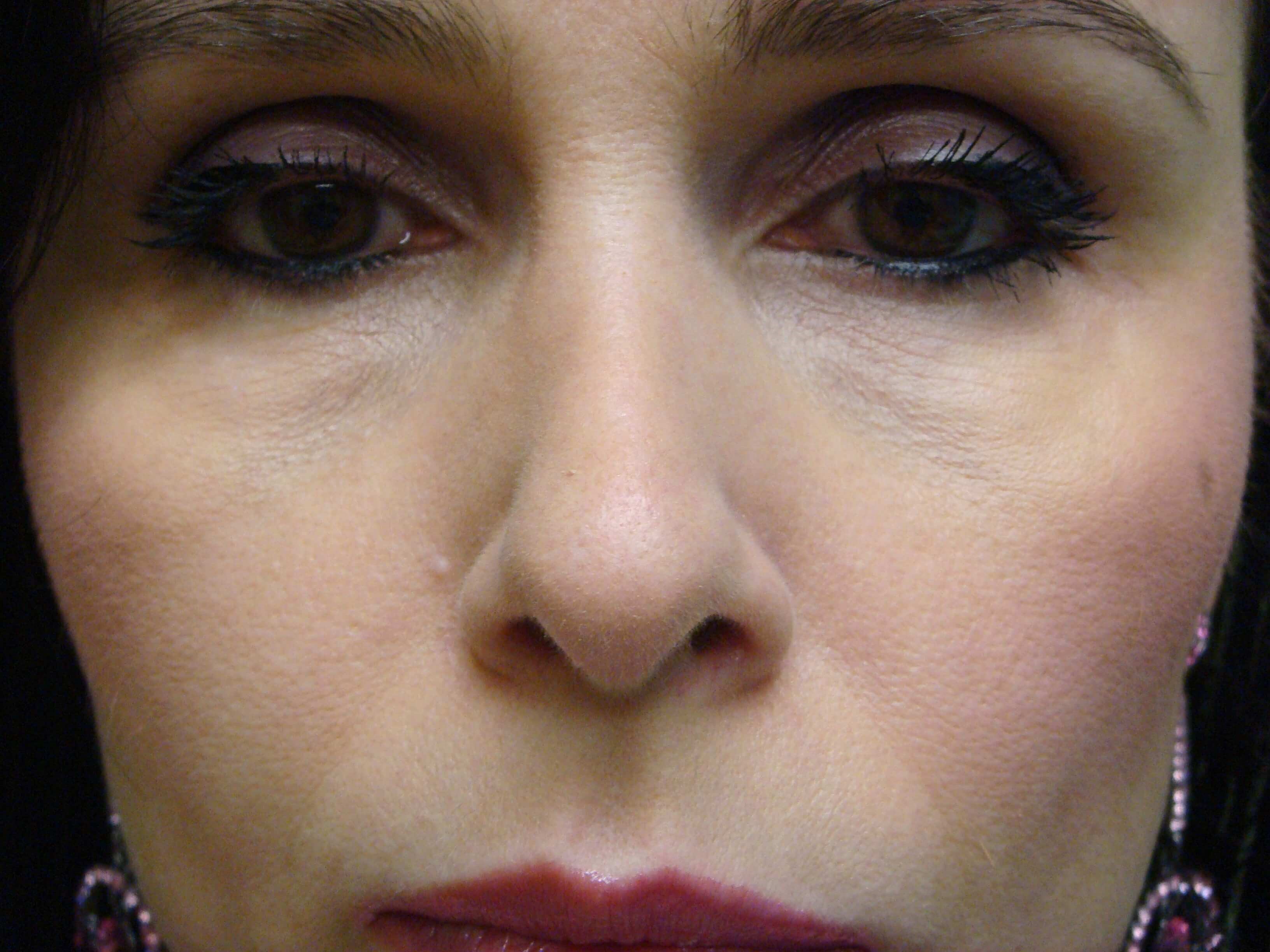 Rhinoplasty After