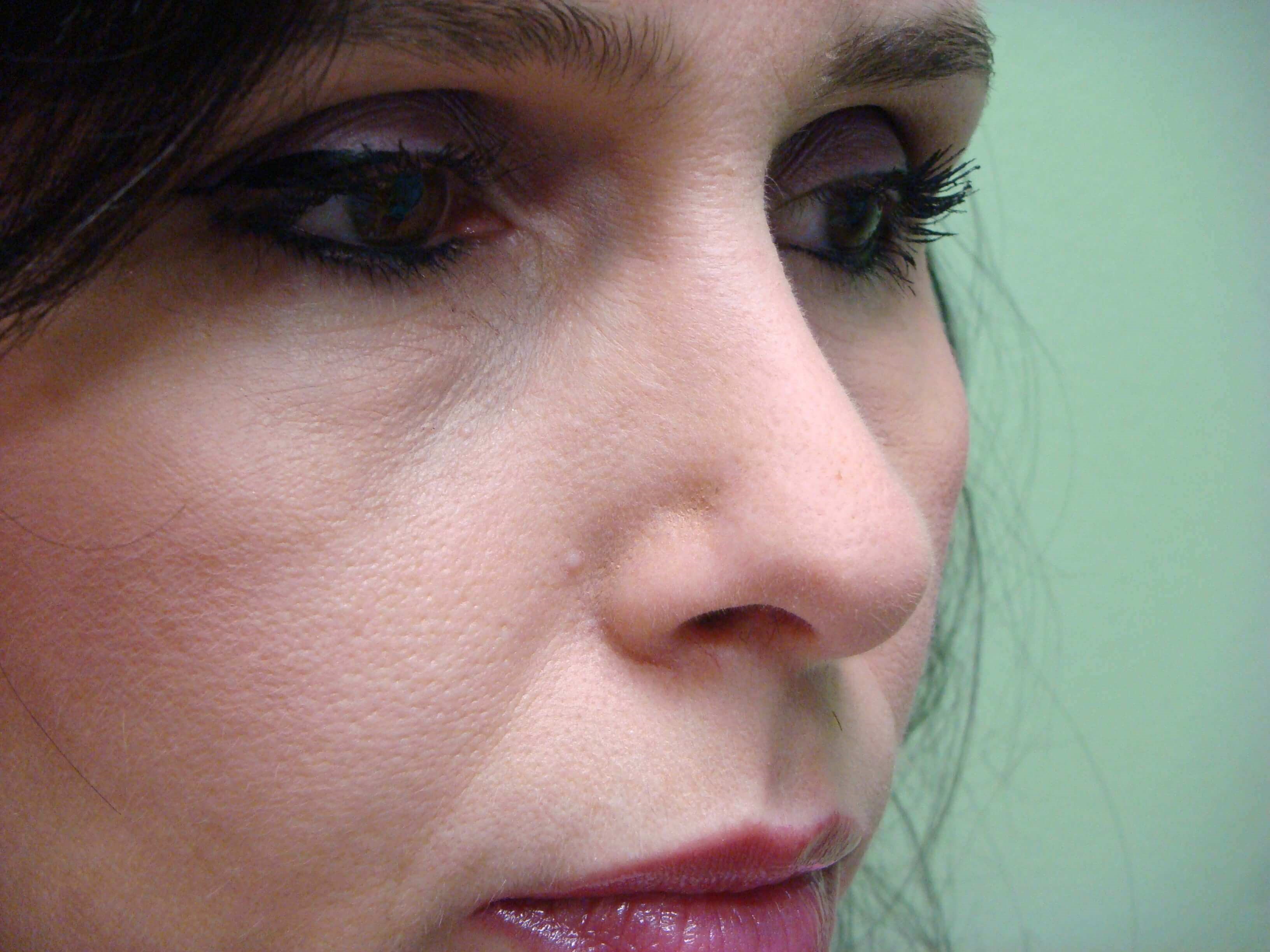Rhinoplasty After