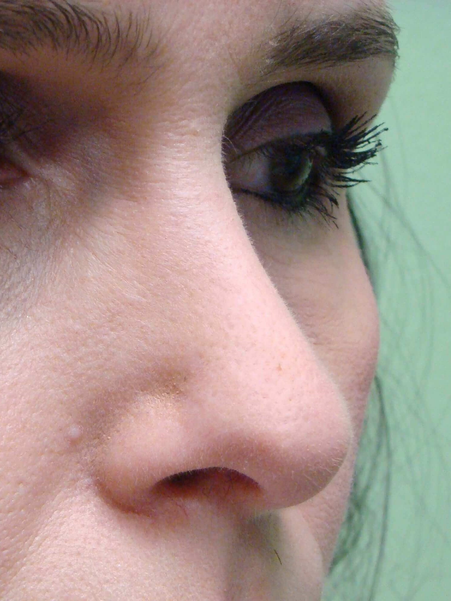 Rhinoplasty After