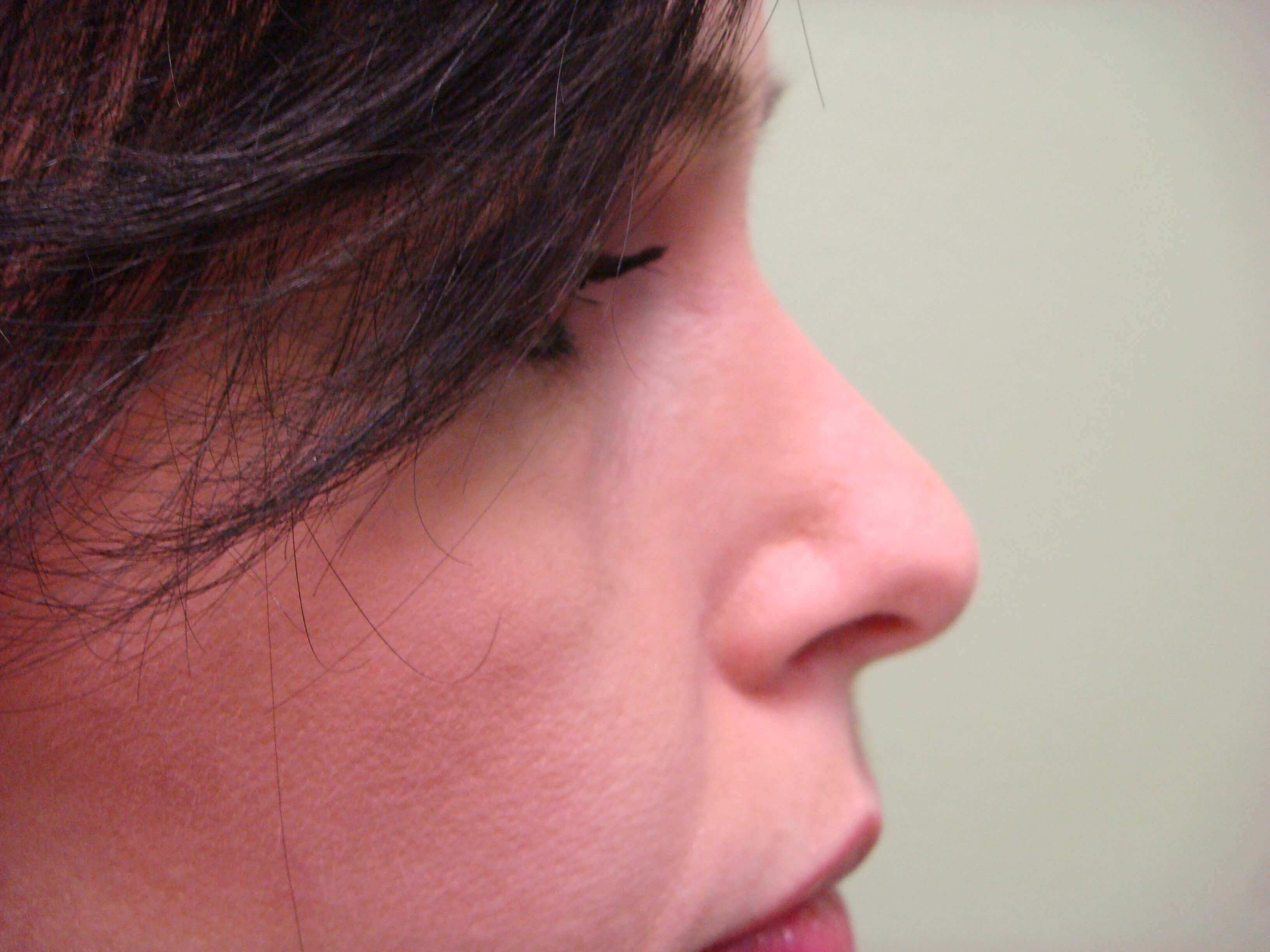Rhinoplasty After