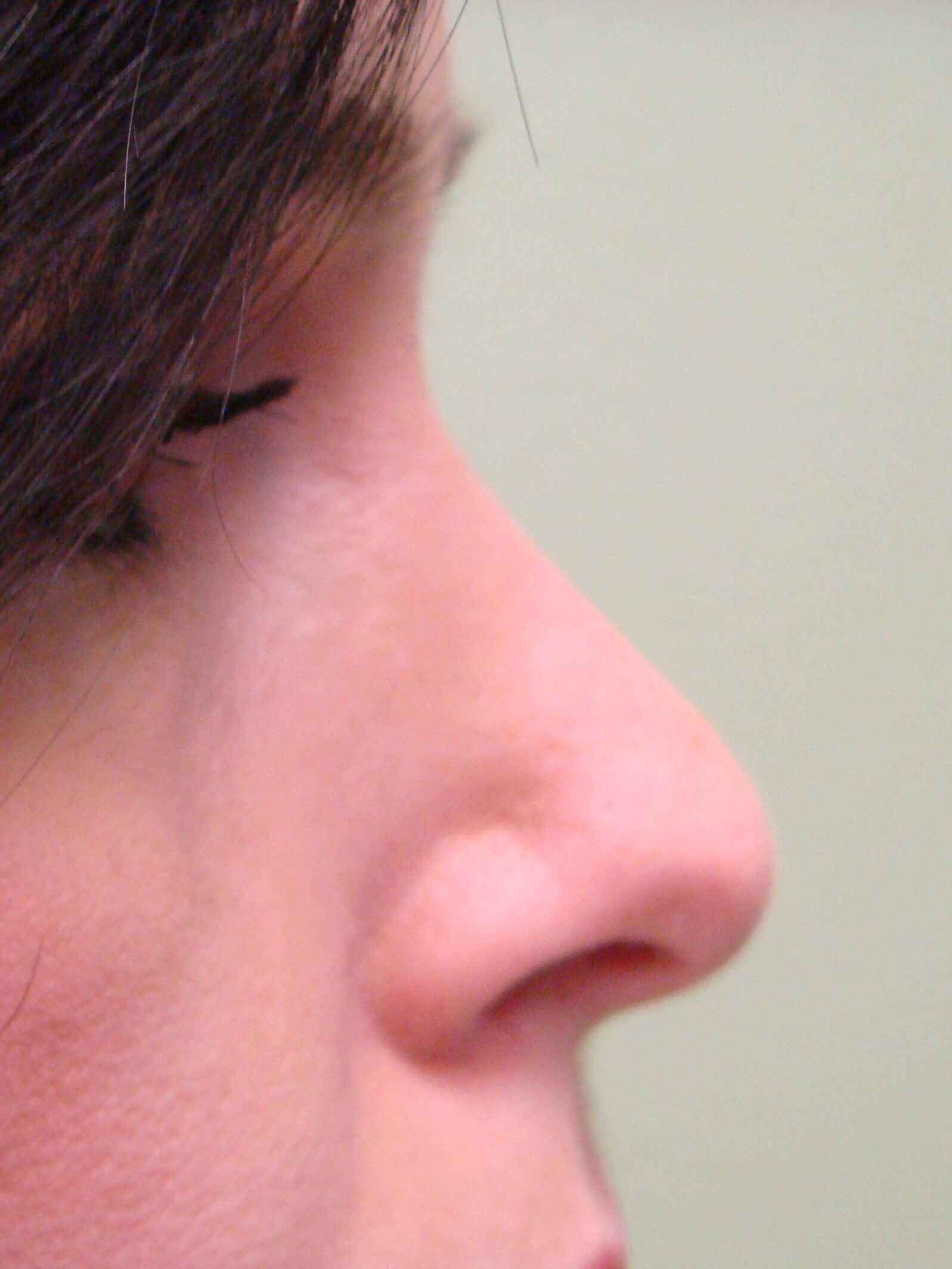 Rhinoplasty After