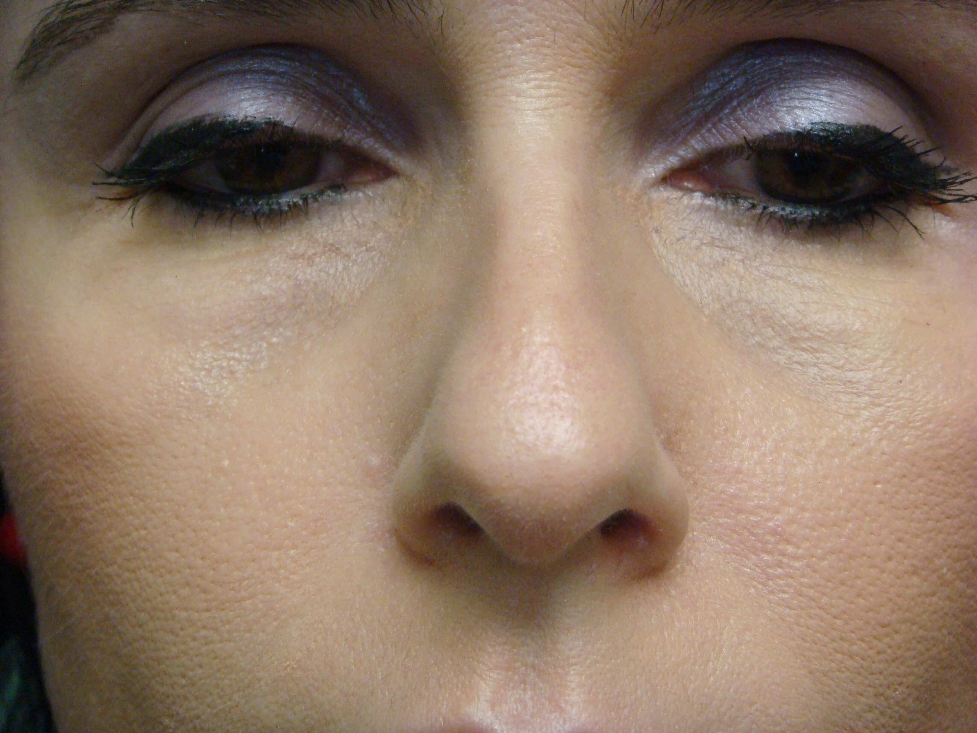 Rhinoplasty Before