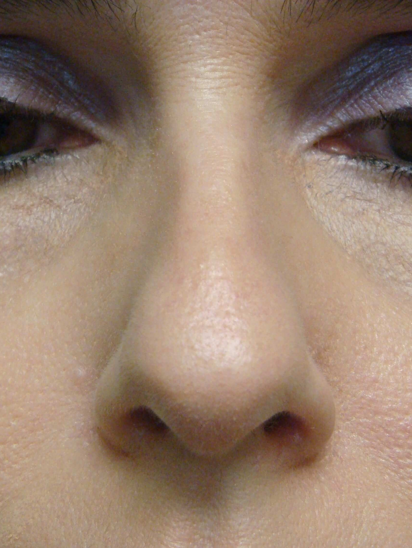 Rhinoplasty Before