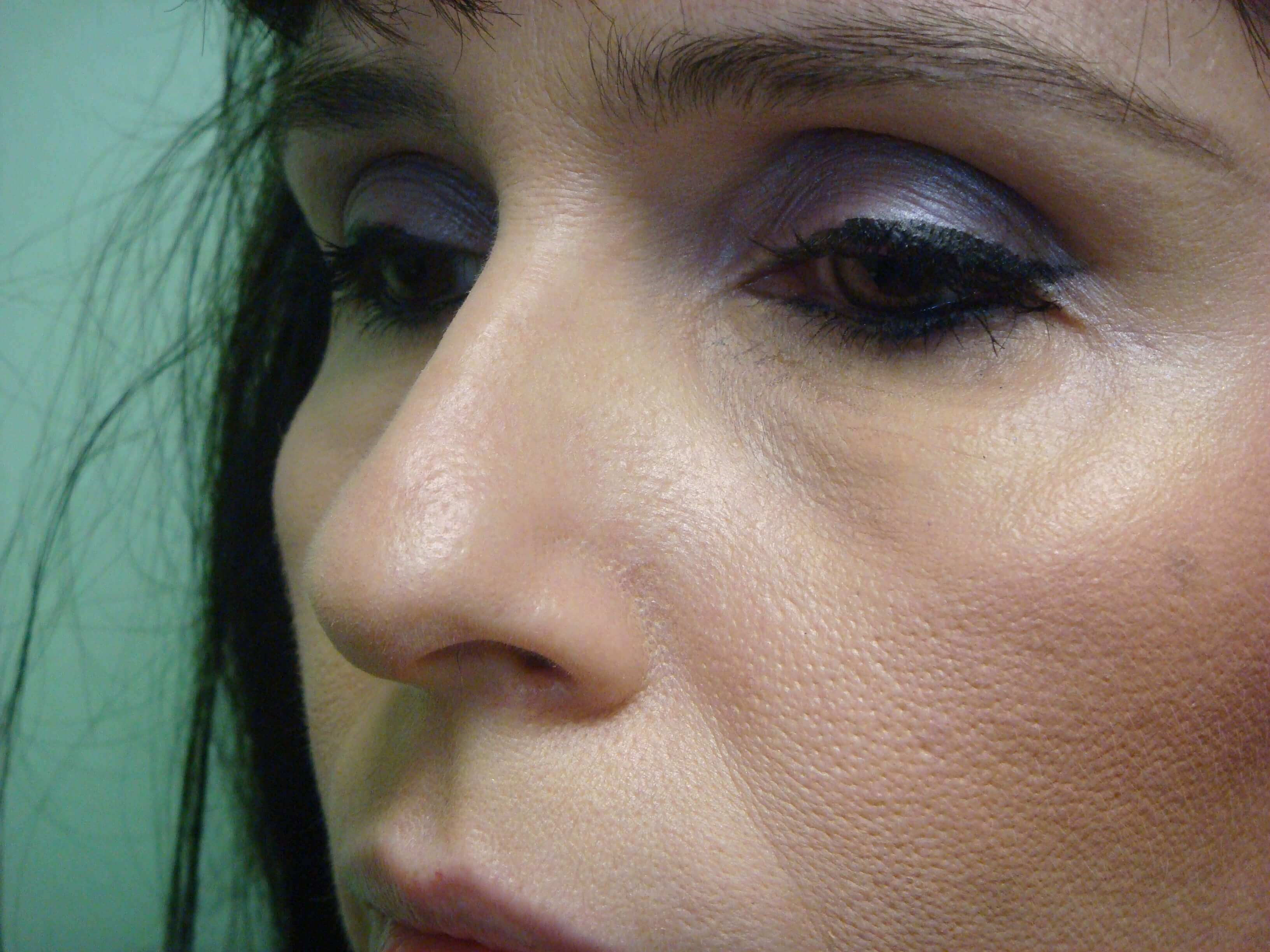 Rhinoplasty Before