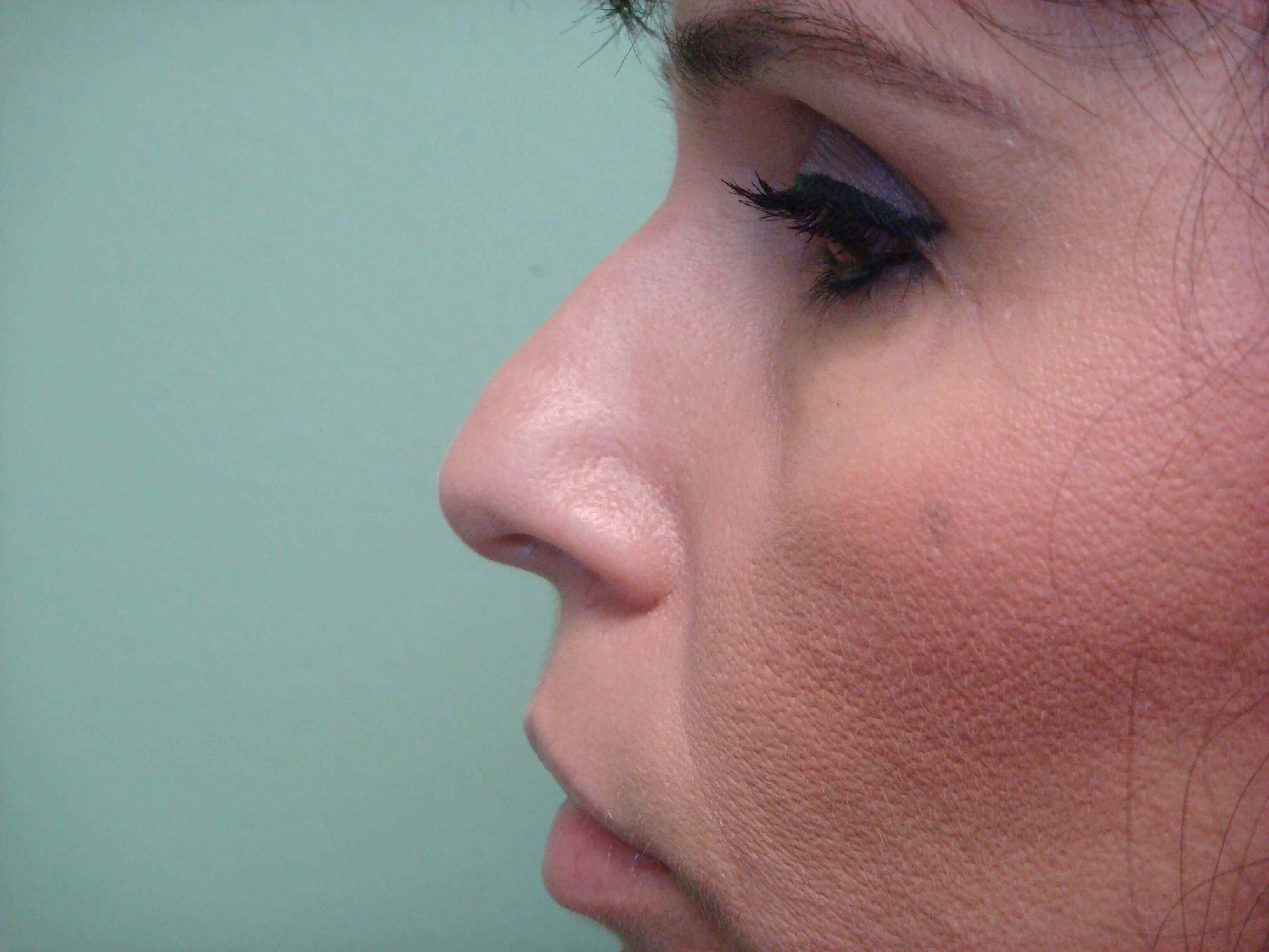 Rhinoplasty Before