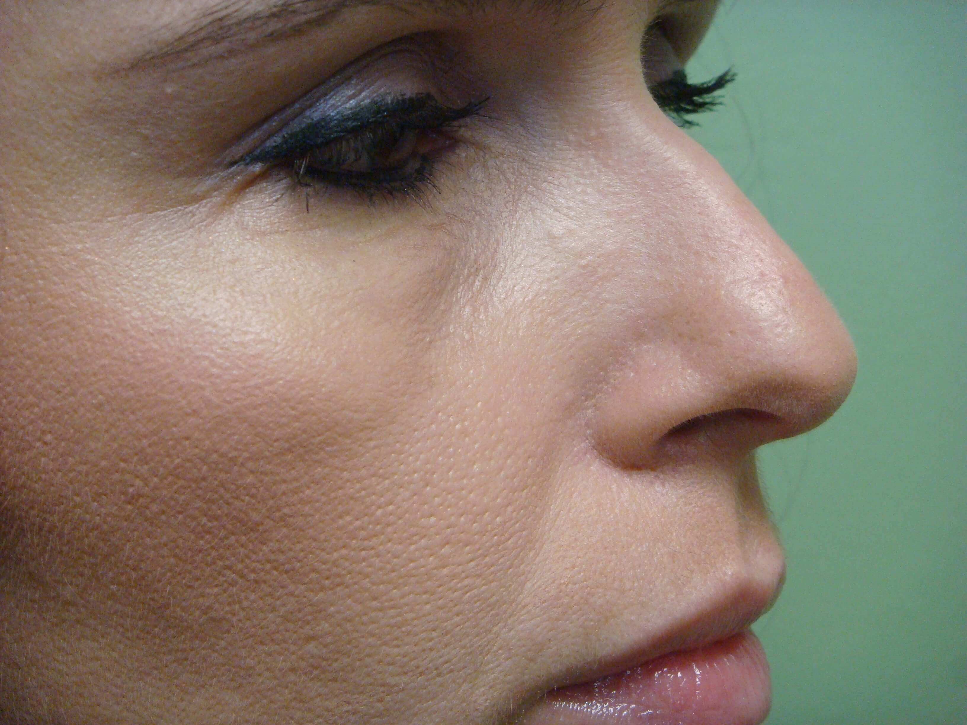 Rhinoplasty Before