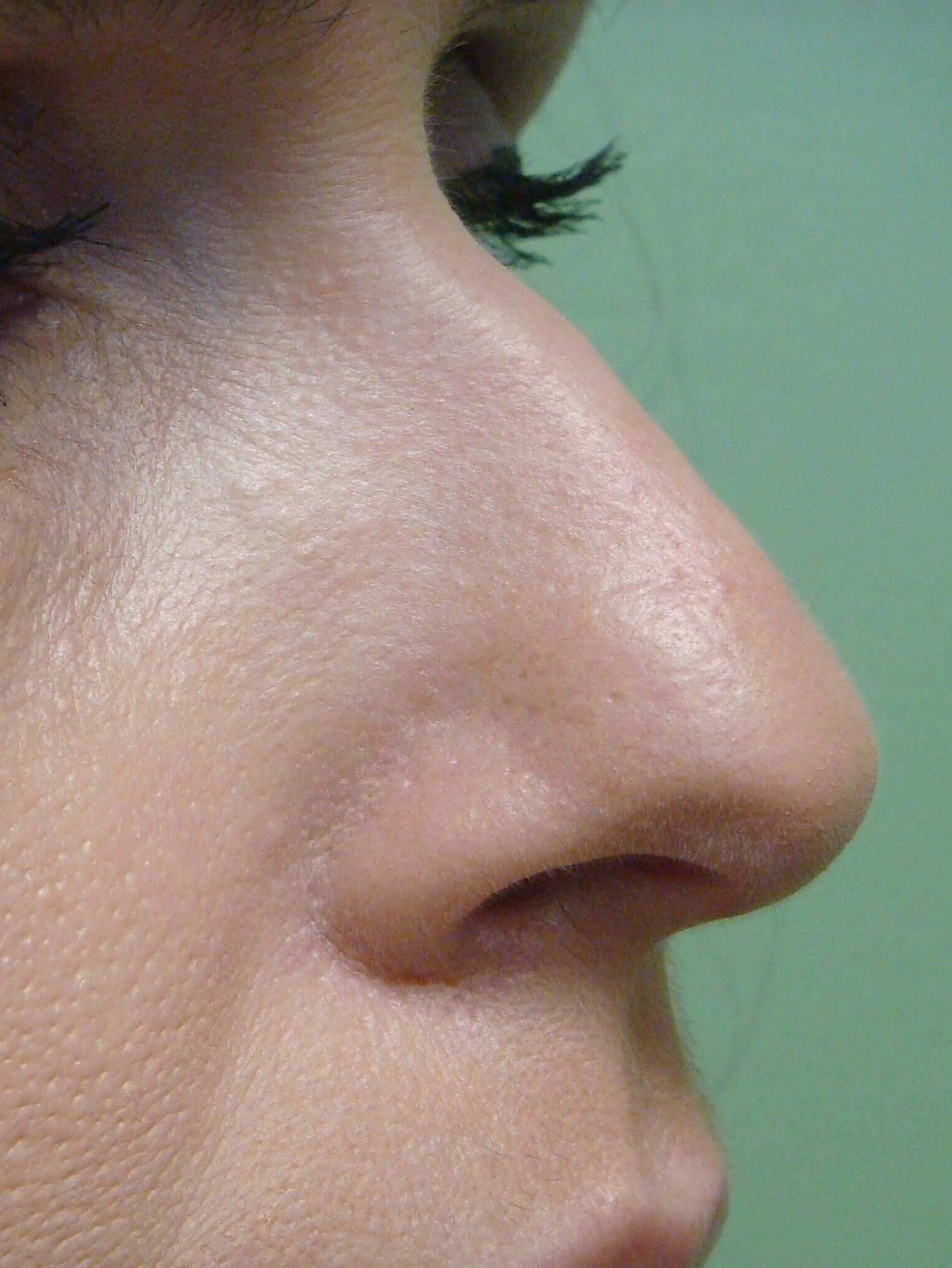 Rhinoplasty Before
