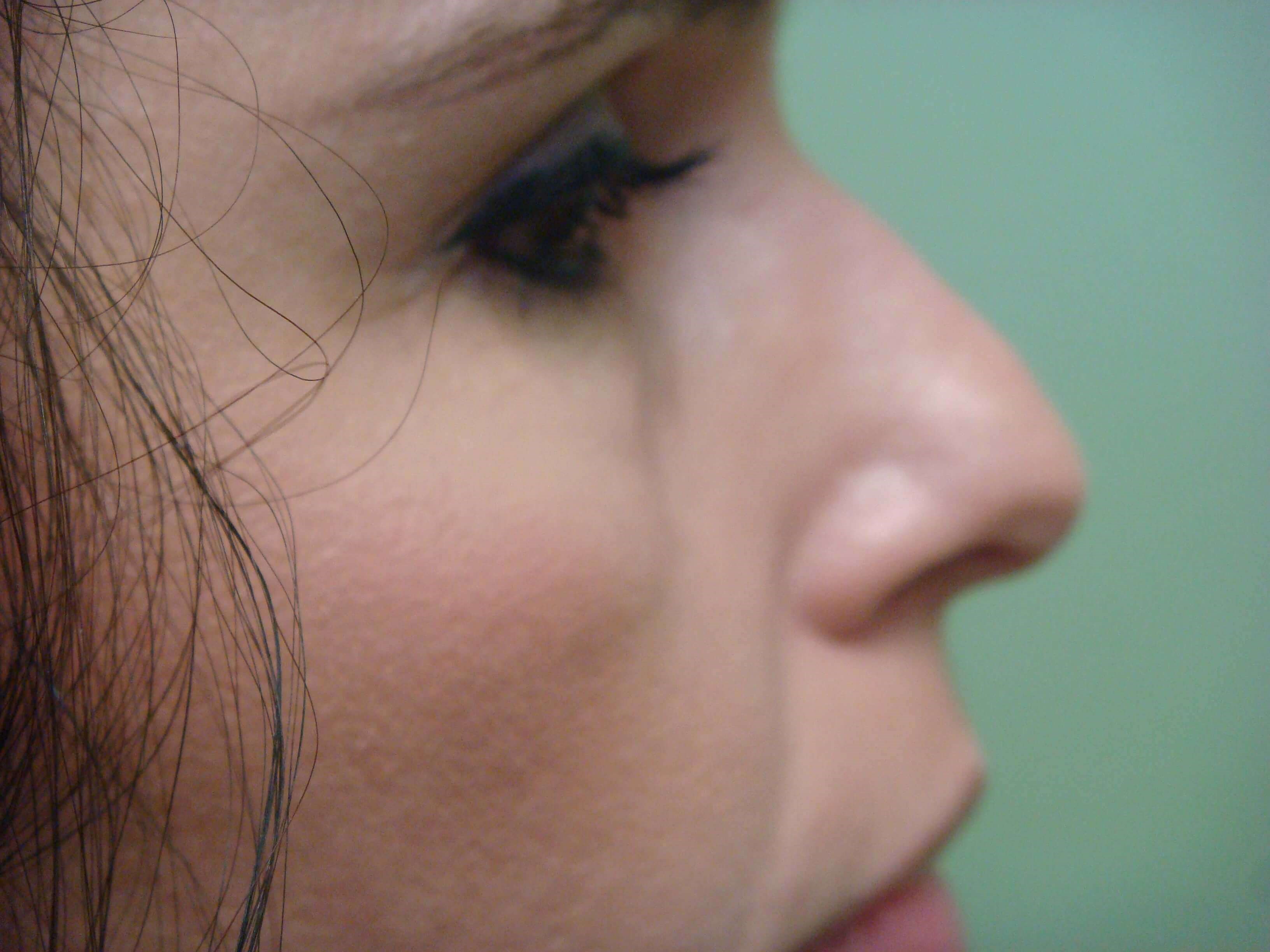 Rhinoplasty Before