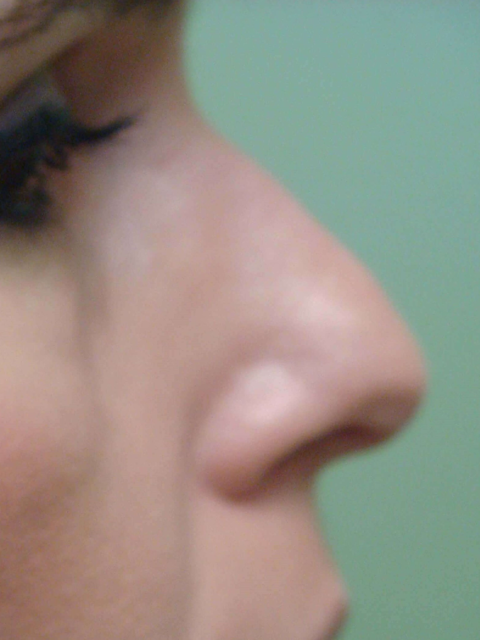 Rhinoplasty Before