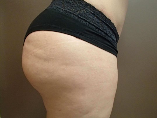 Brazilian Butt Lift (BBL) After