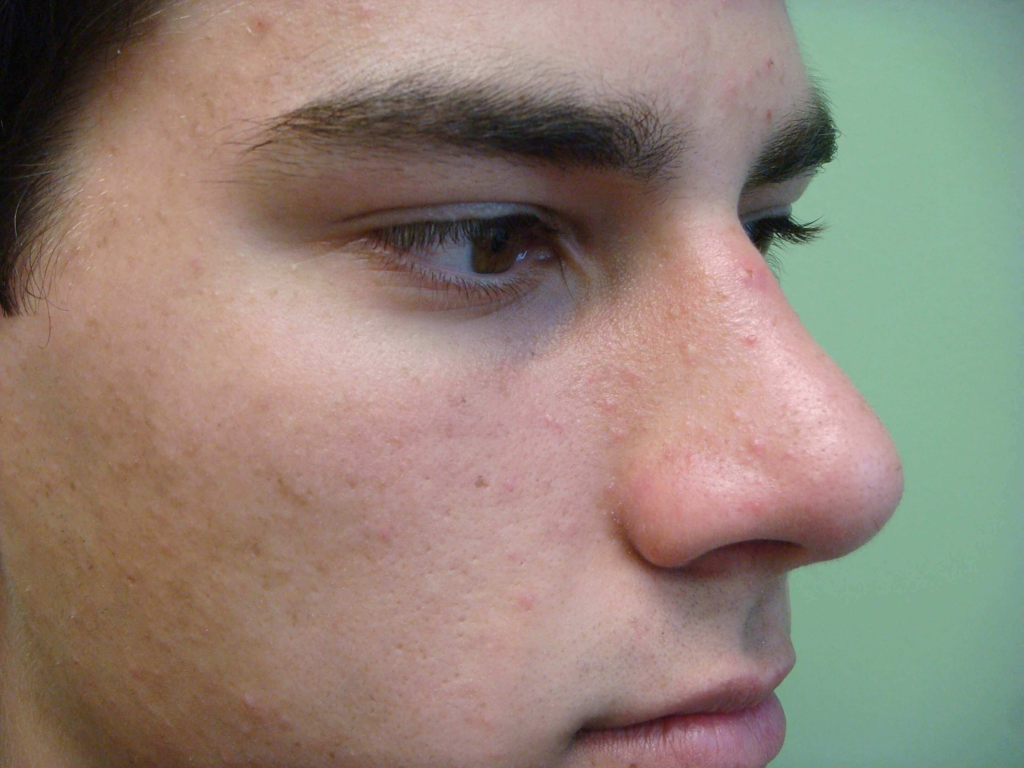 Rhinoplasty After