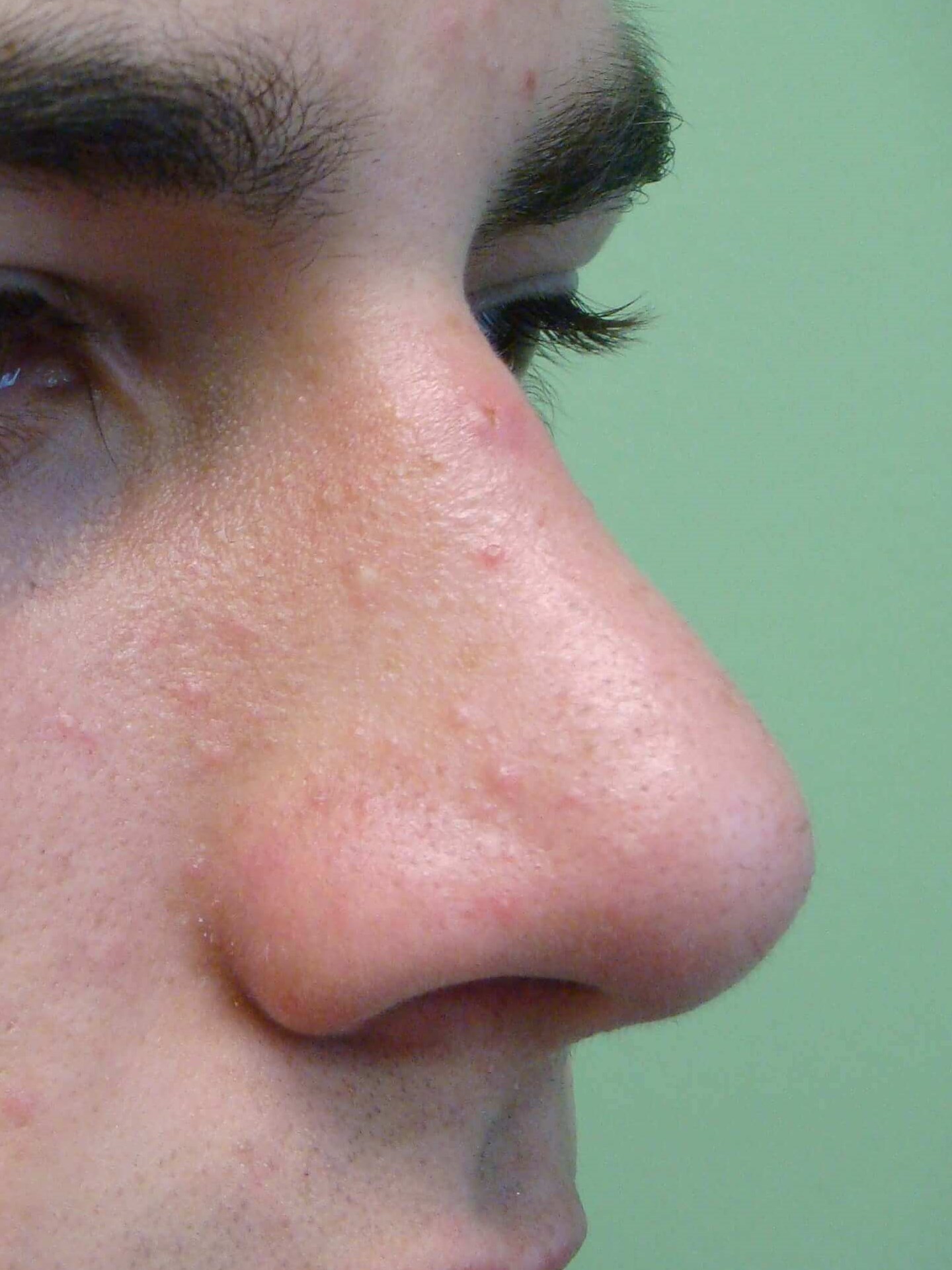 Rhinoplasty After