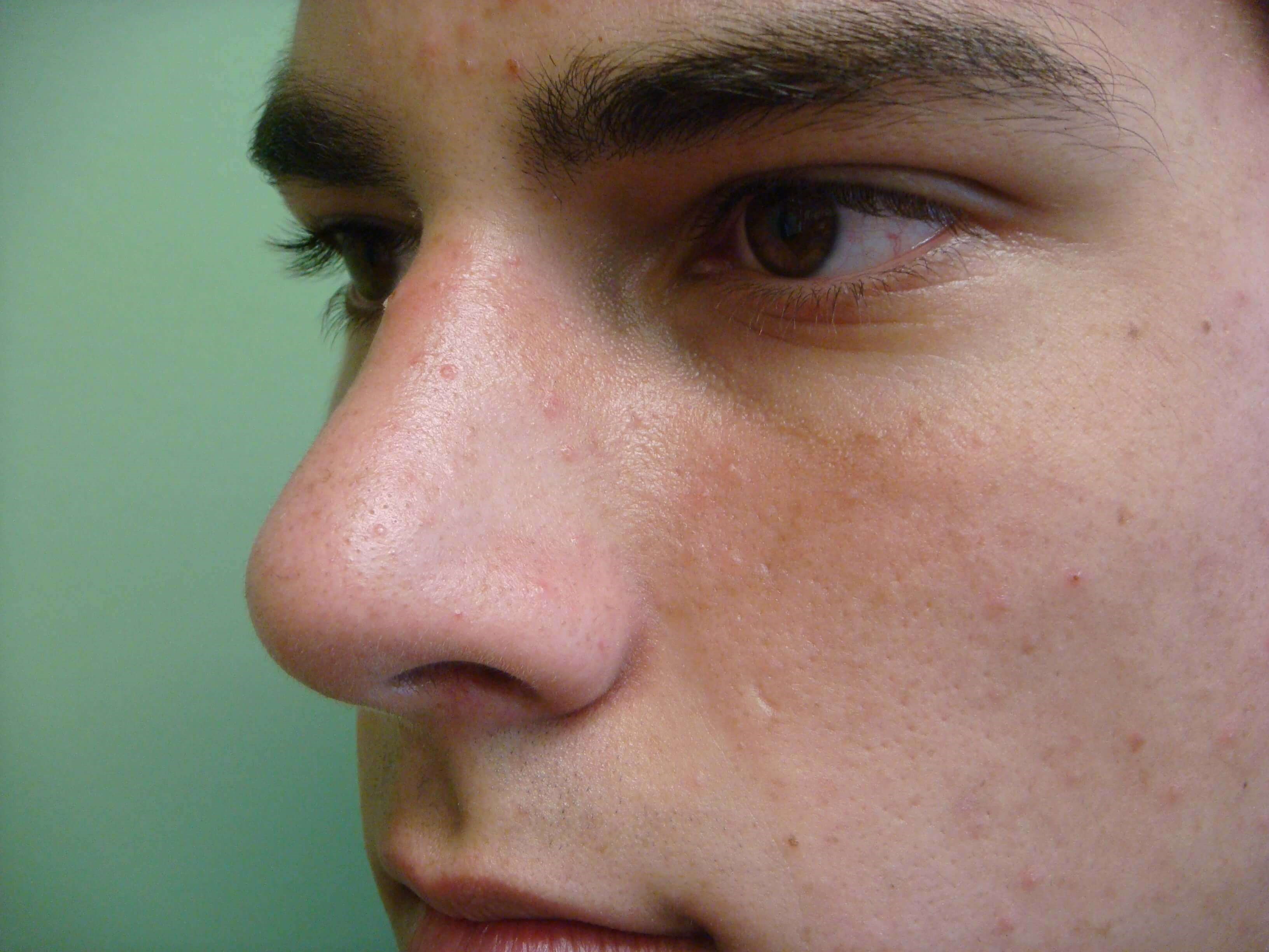 Rhinoplasty After