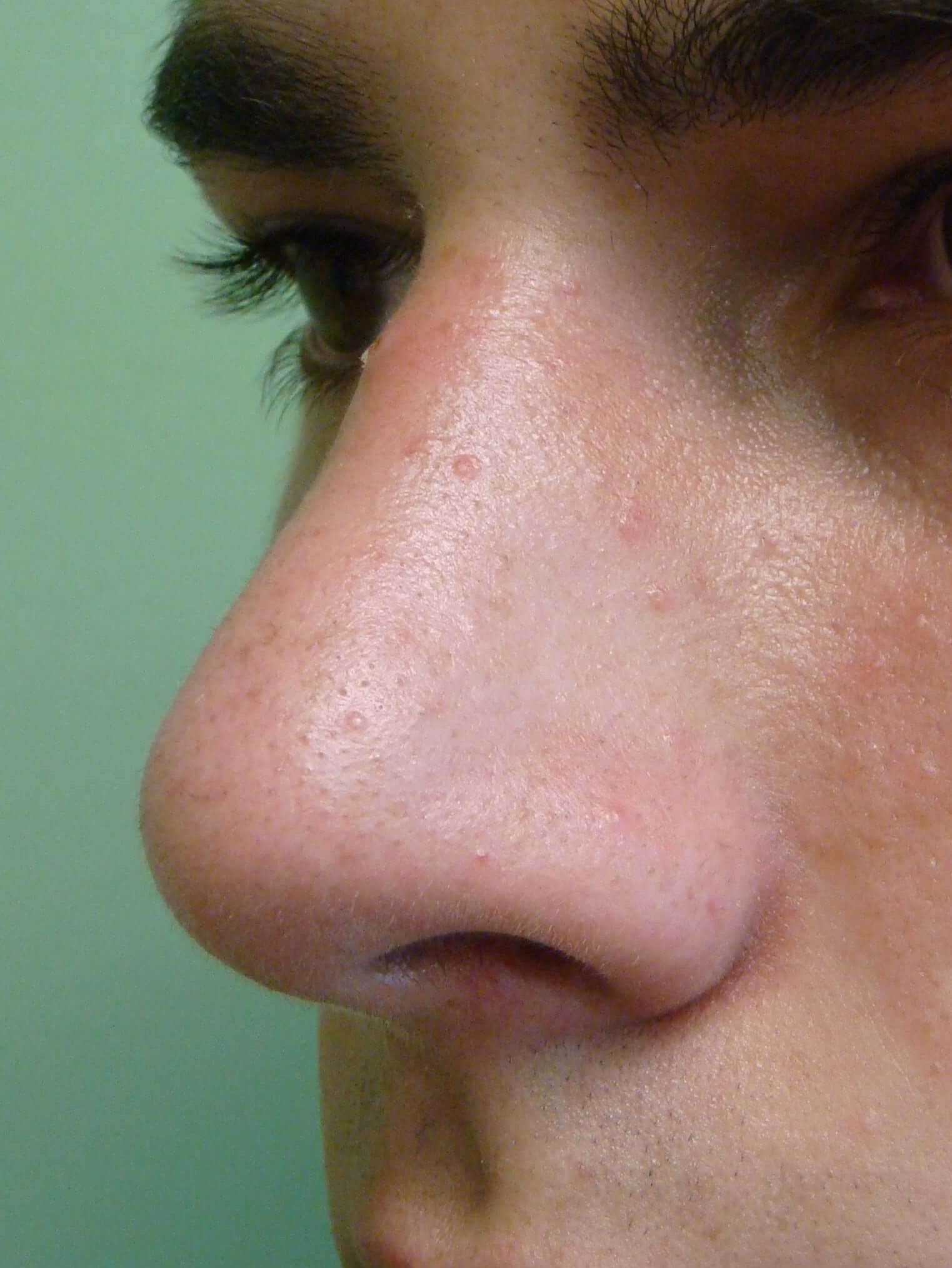 Rhinoplasty After