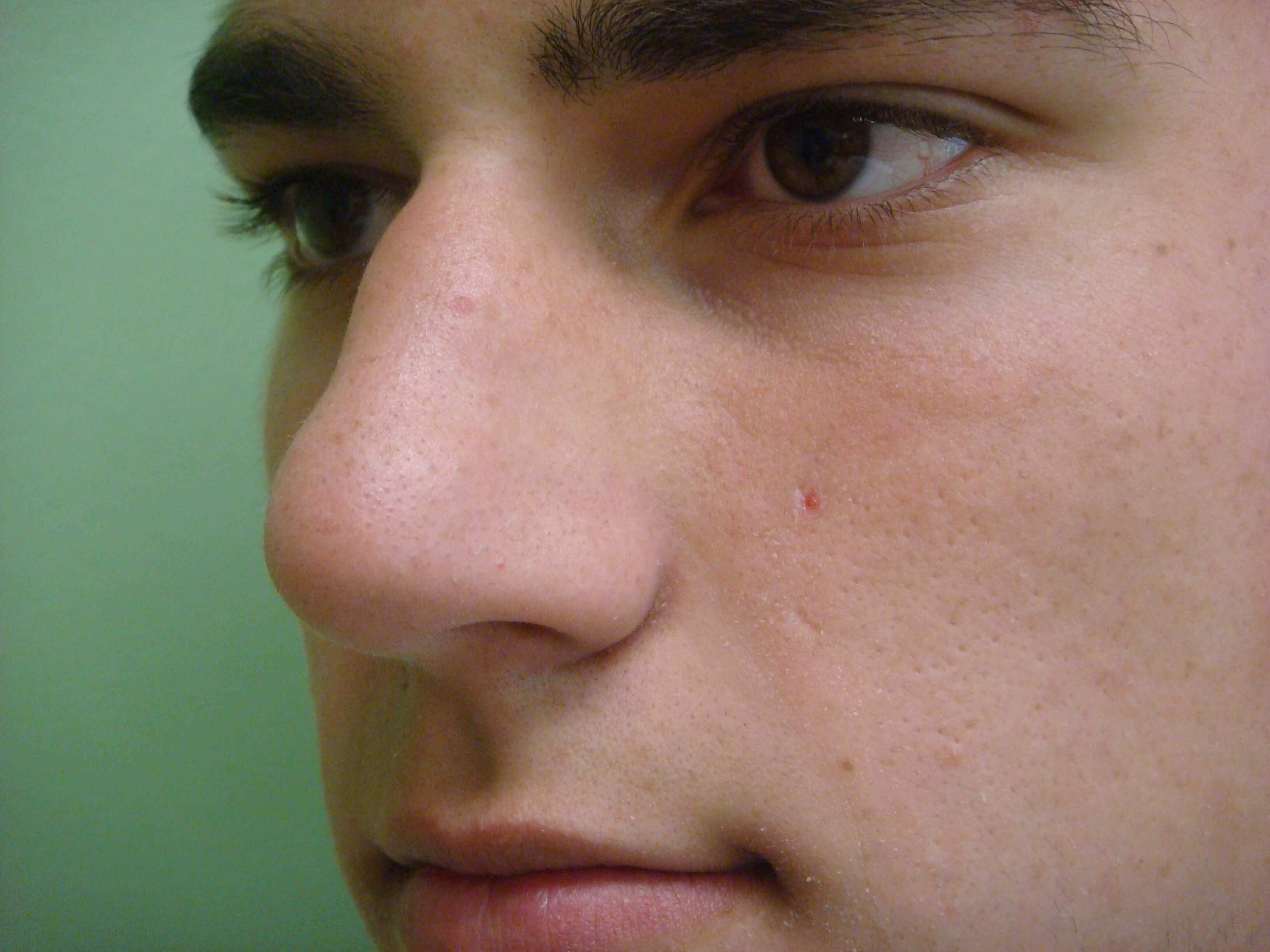 Rhinoplasty Before