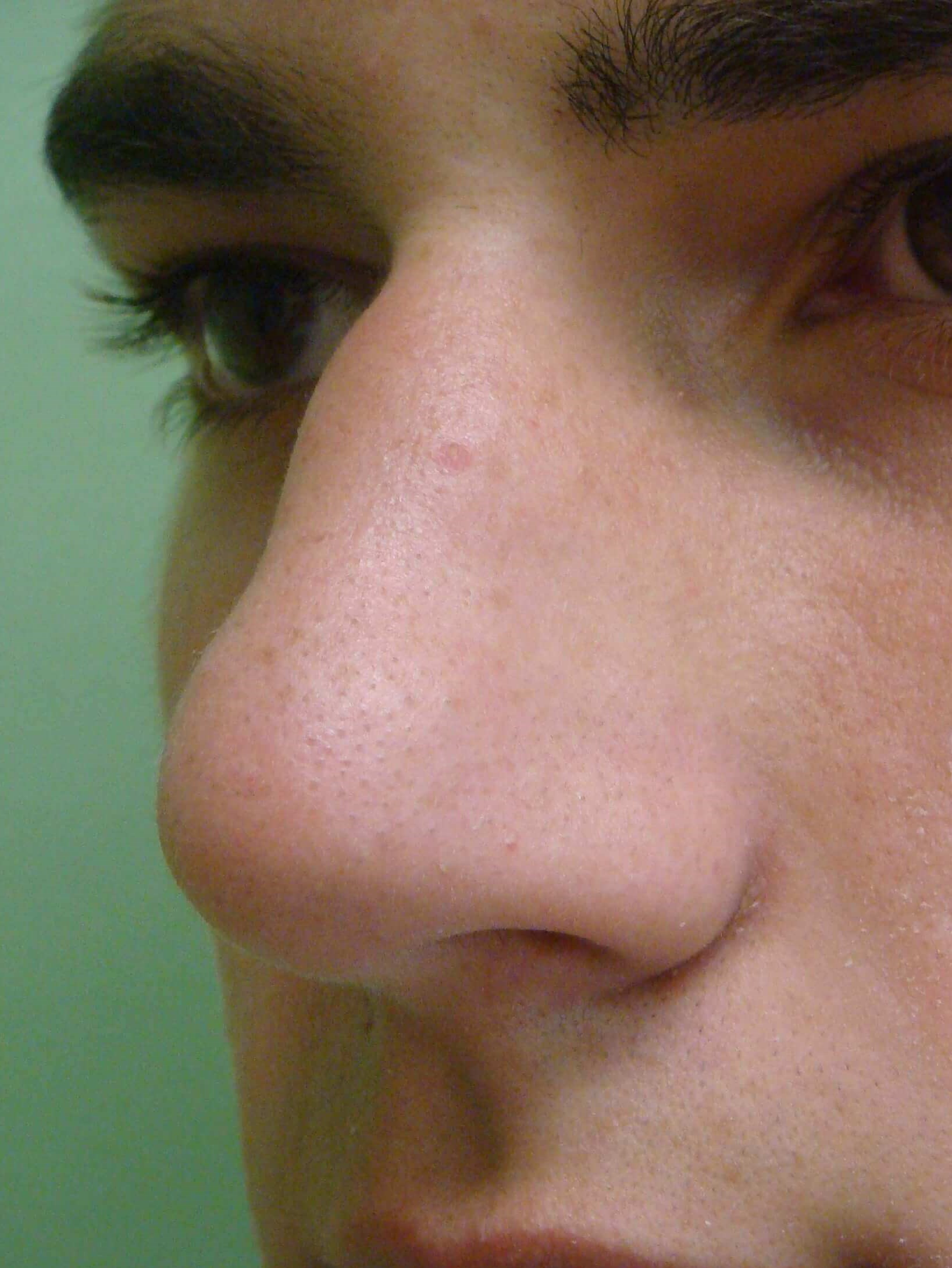 Rhinoplasty Before