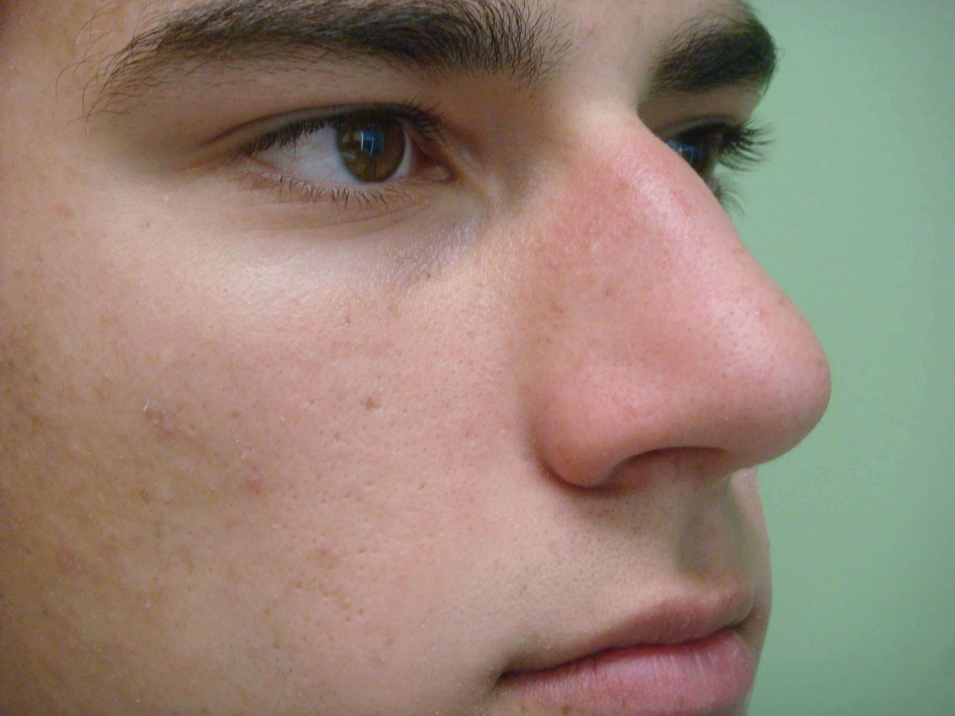 Rhinoplasty Before