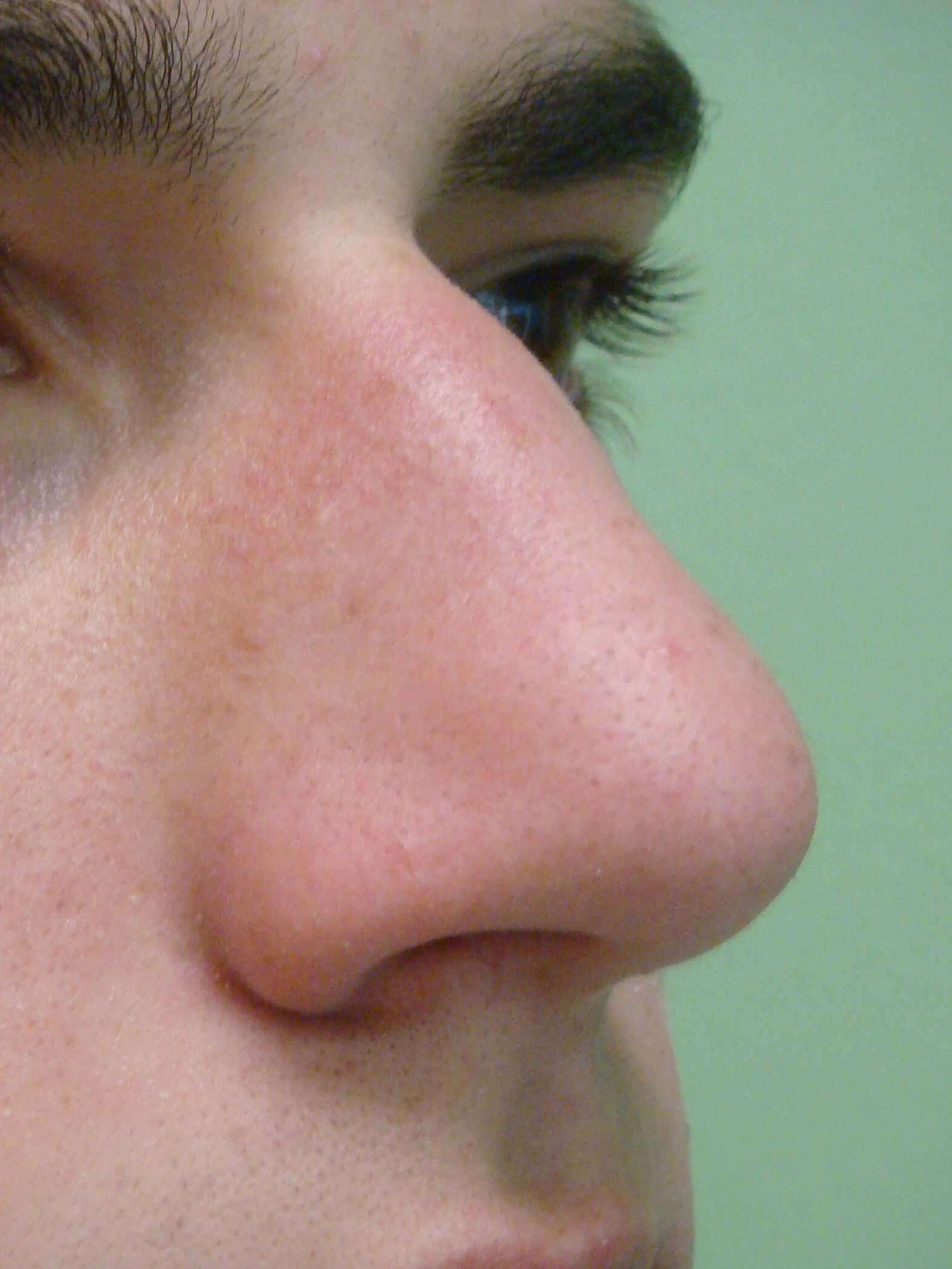 Rhinoplasty Before