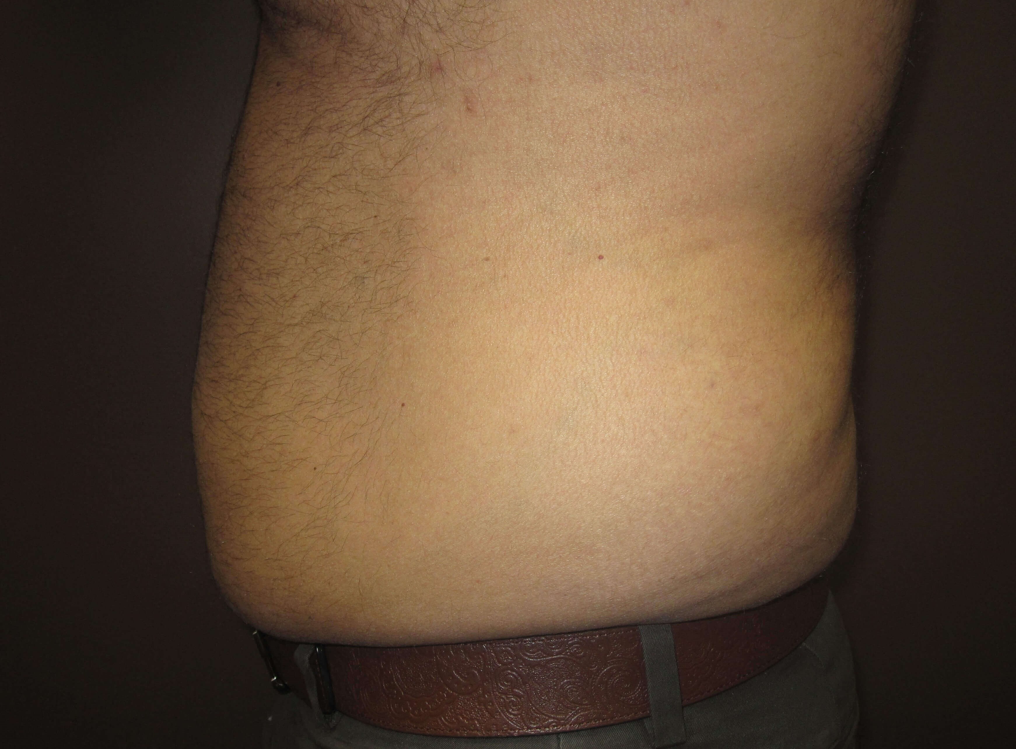 Liposuction Before
