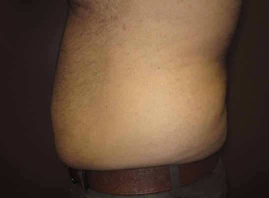 Liposuction Before
