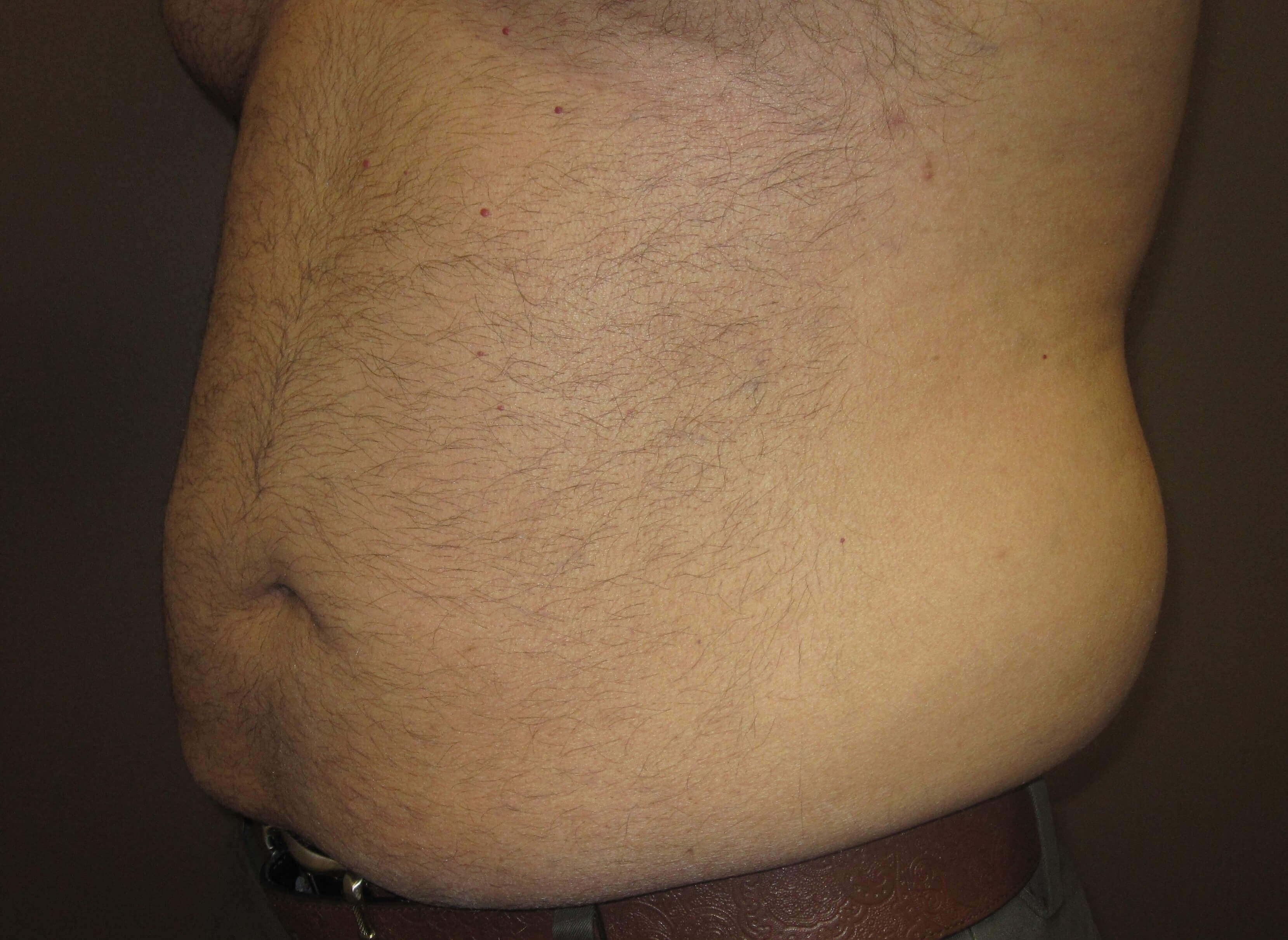 Liposuction Before