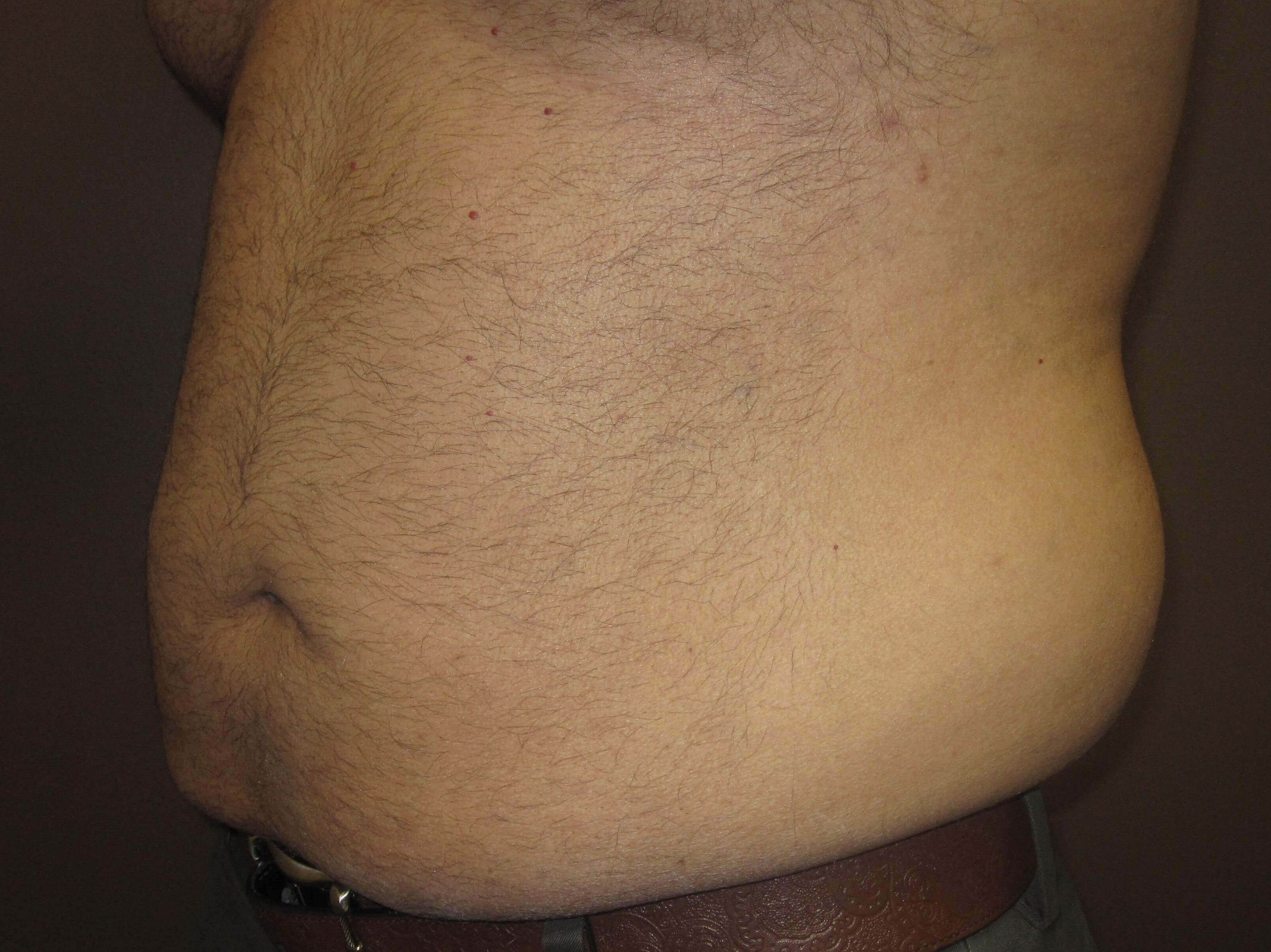 Liposuction Before