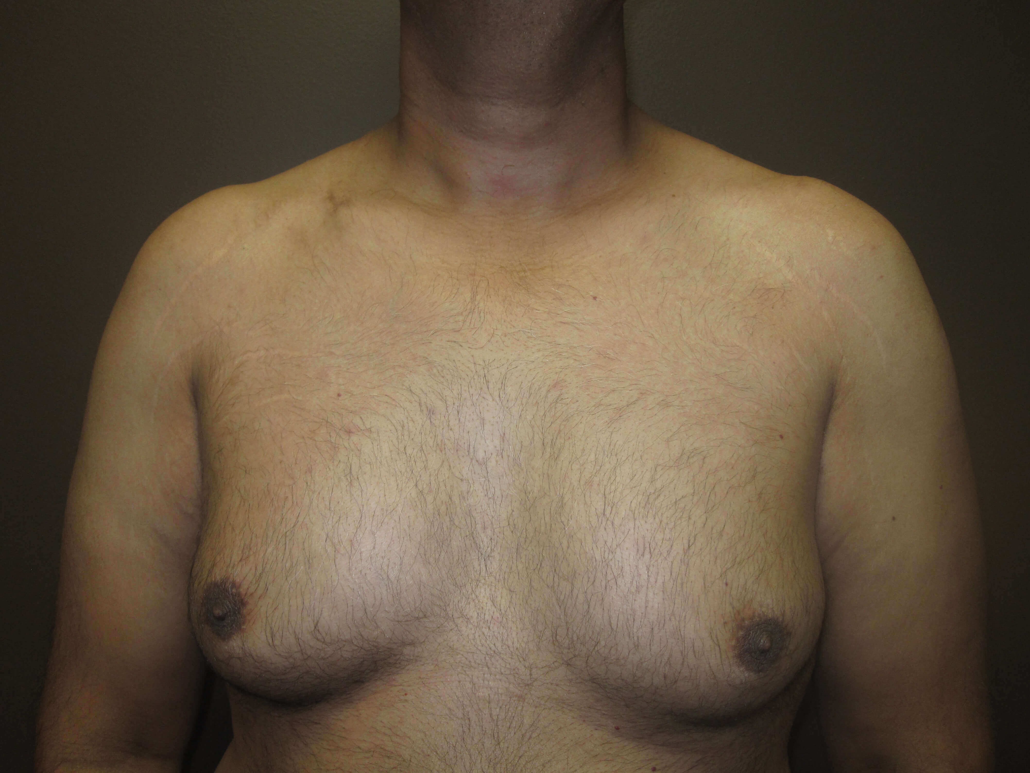 Liposuction Before