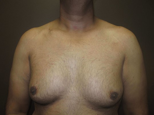 Liposuction Before