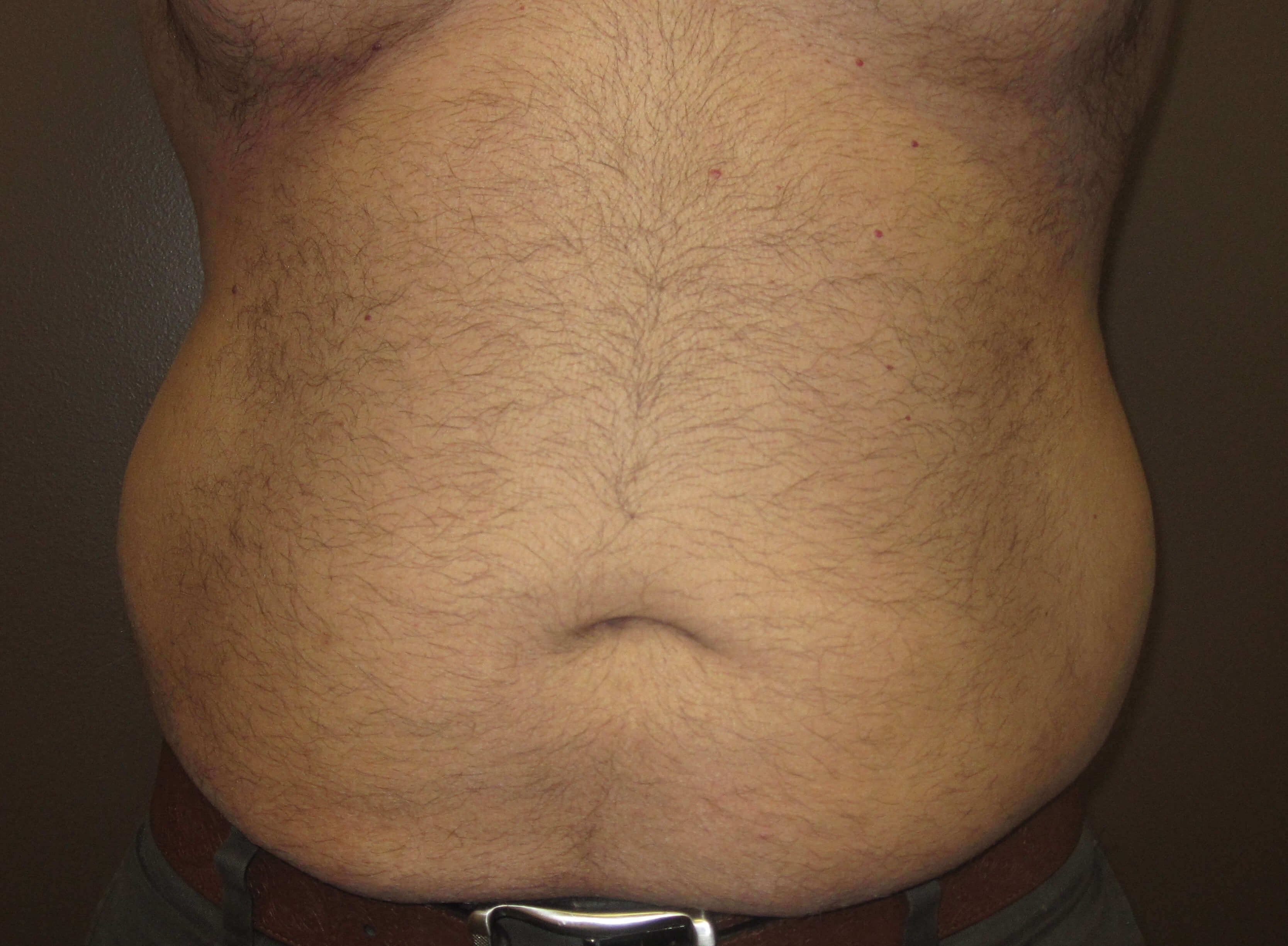 Liposuction Before