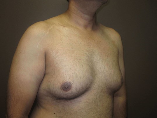 Liposuction 