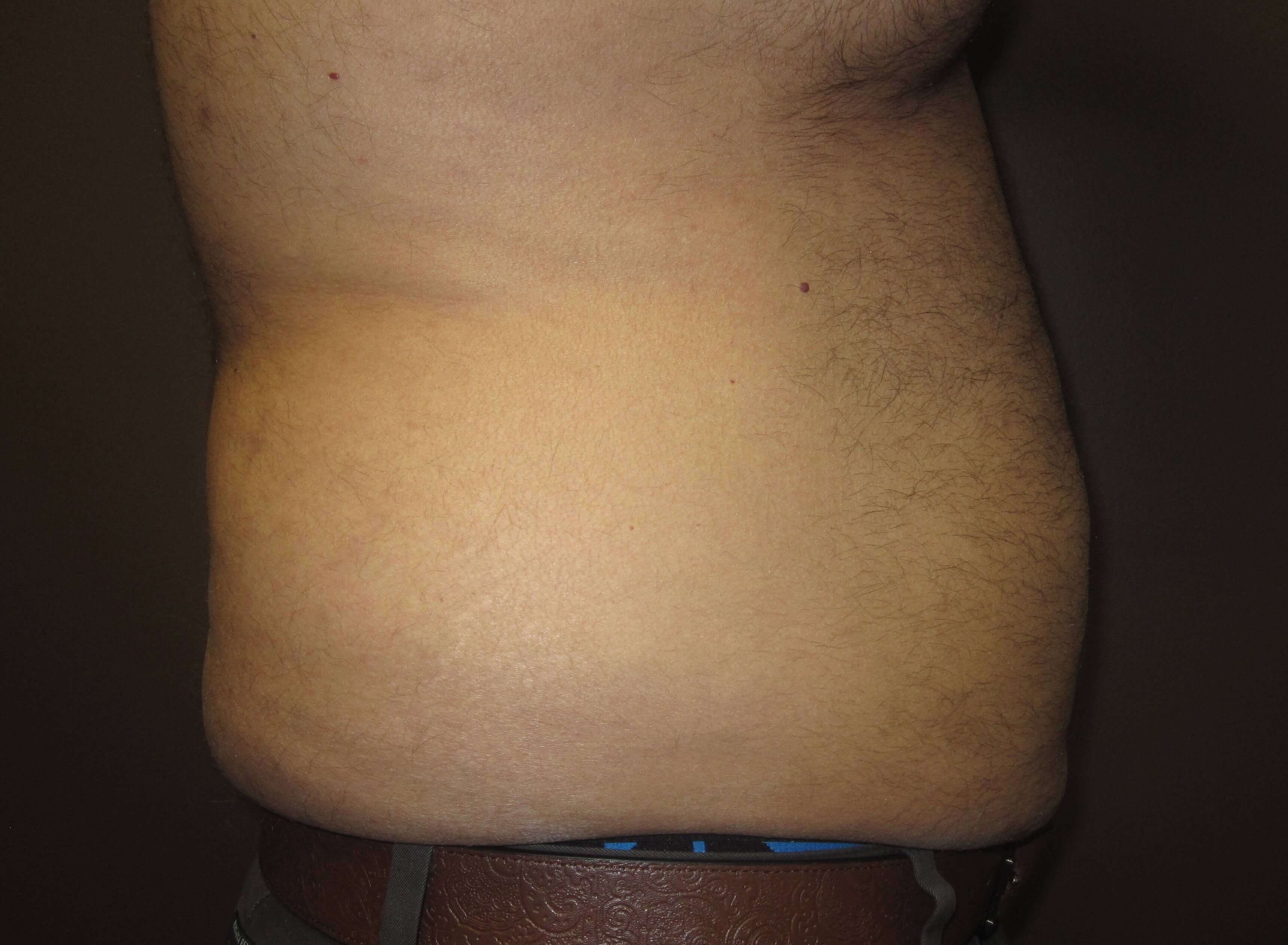 Liposuction Before