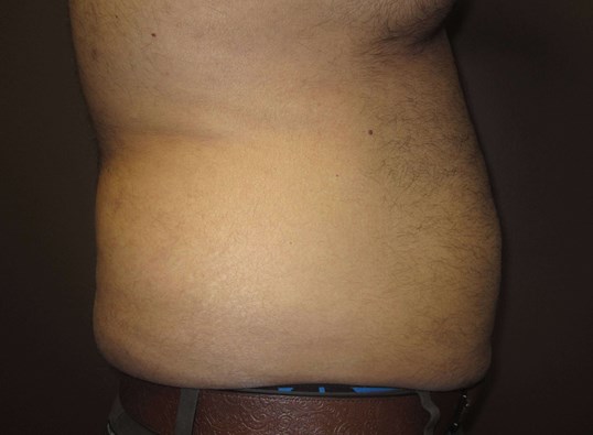 Liposuction Before