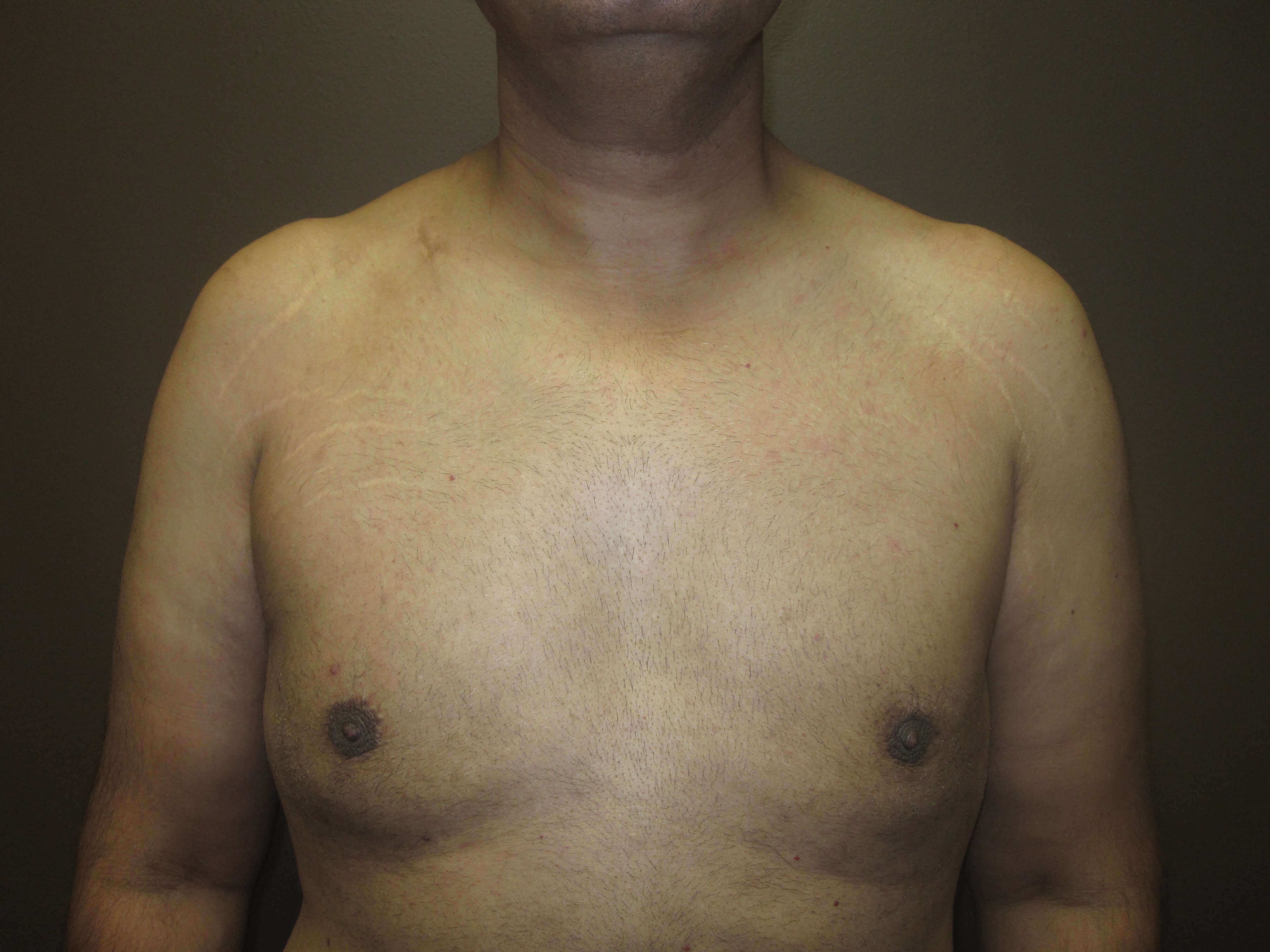 Liposuction After