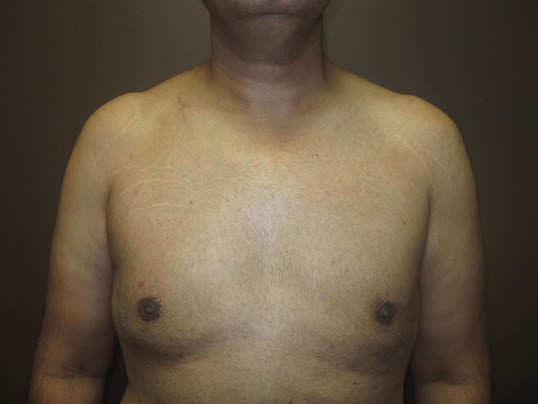 Liposuction After