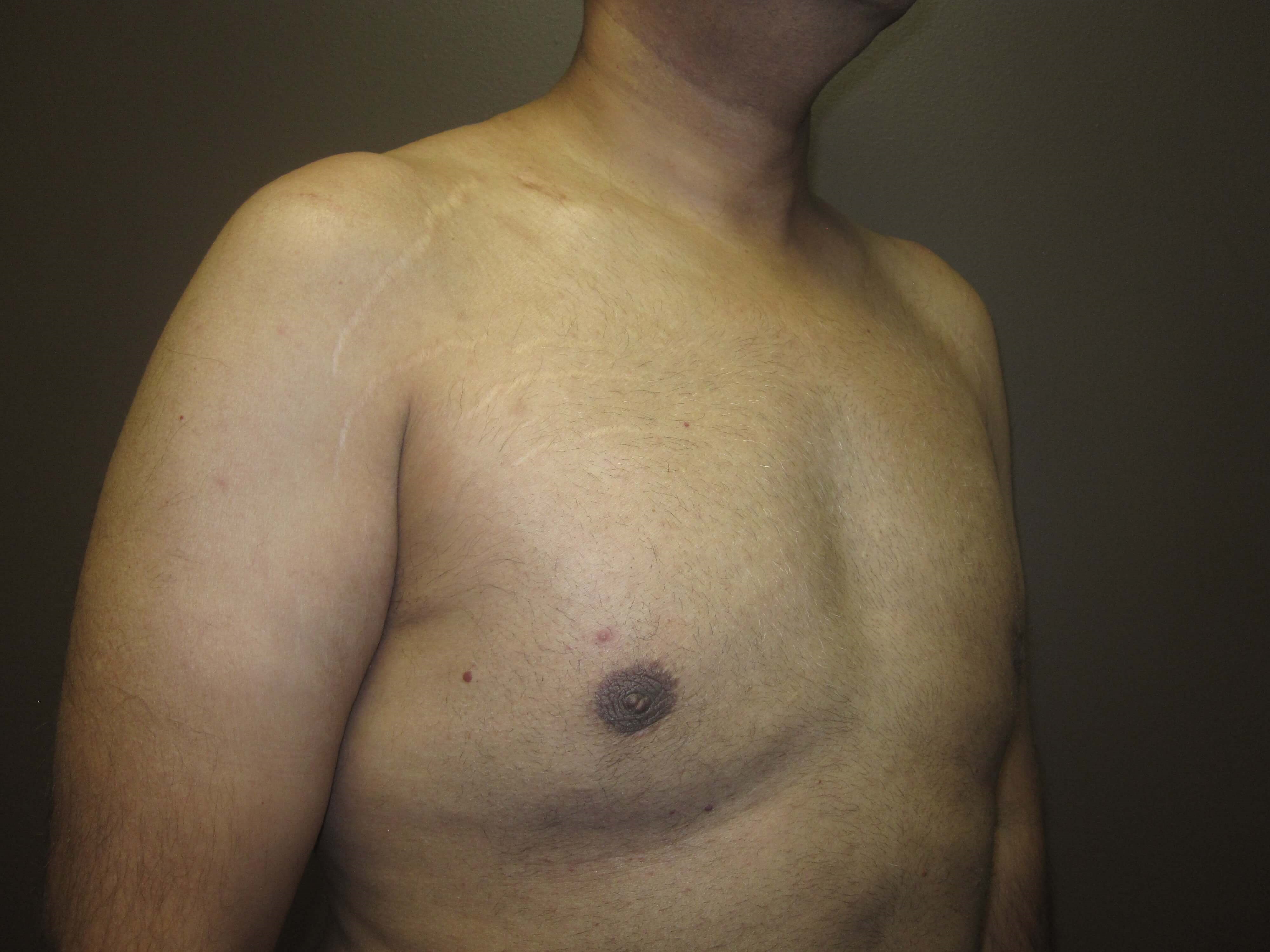 Liposuction 
