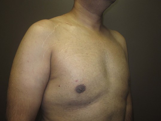 Liposuction 